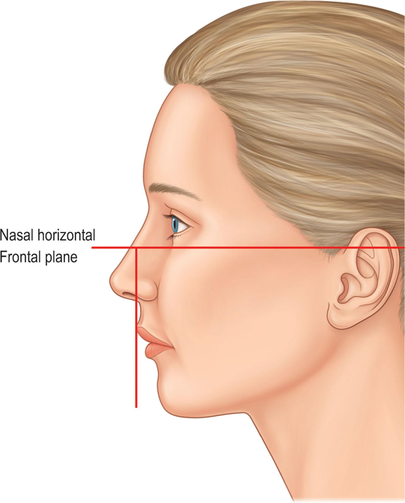 Figure 18.8, For measurements, especially angular values, to be reproducible, head position is standardized. Here the Frankfort horizontal is shown: the line from the external auditory canal to the orbital rim is parallel to the horizon.