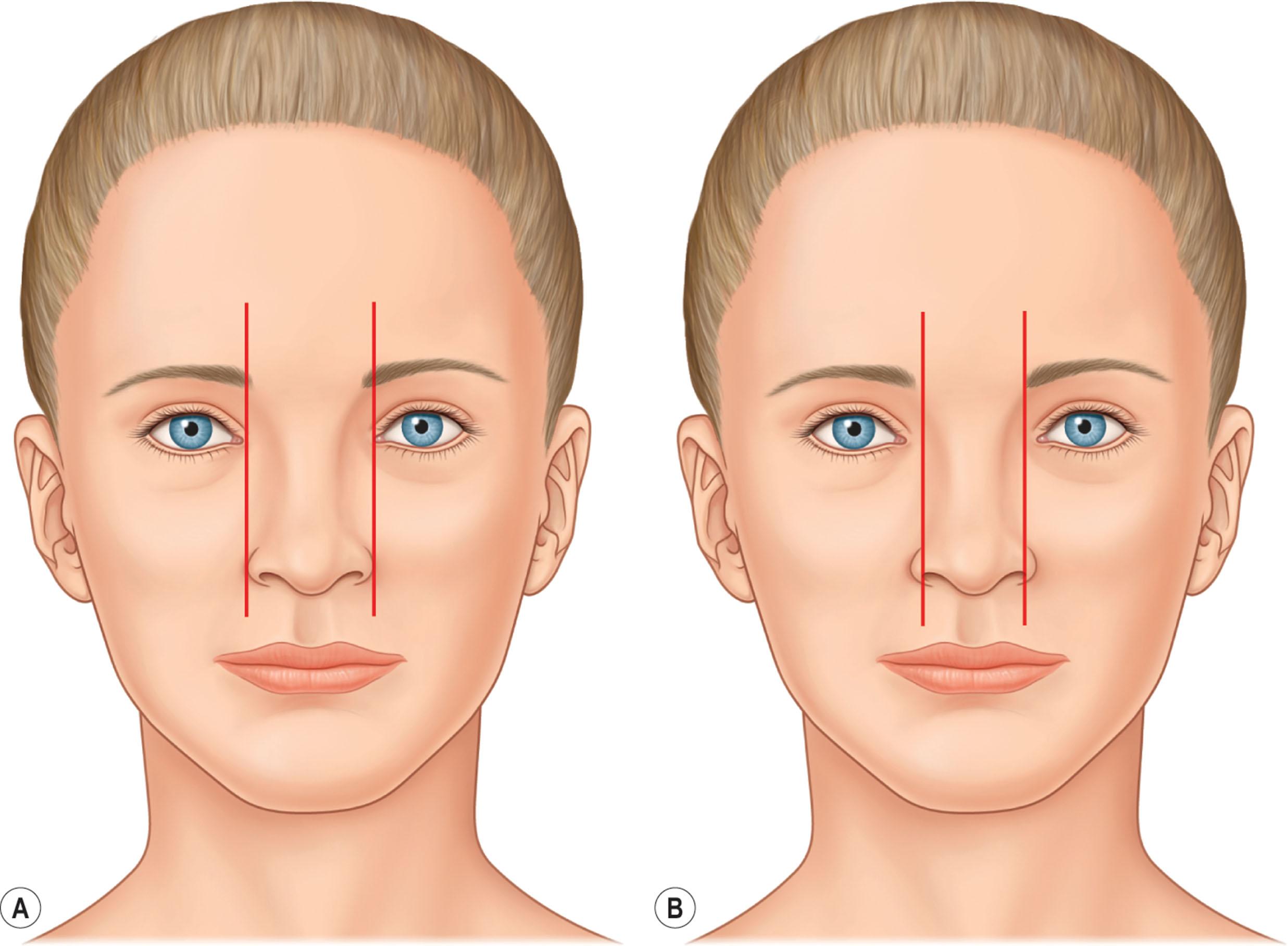 Figure 18.9, The width of the bony base relative to the alar base is then assessed. (A) The bony base width should be 80% of the normal alar base width. (B) A normal alar base width is equal to the intercanthal distance or the width of one eye.