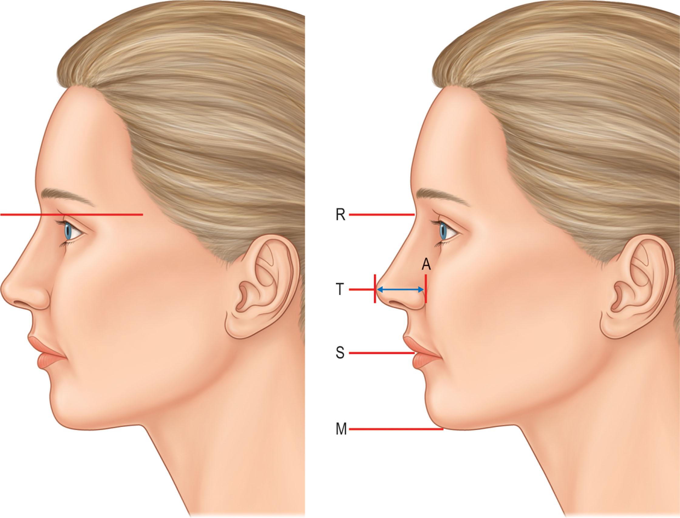 Figure 18.10, With the head in the standardized position, nasal length and tip projection are analyzed. A, Alar base; M, menton; R, radix; S, stomium; T, tip.