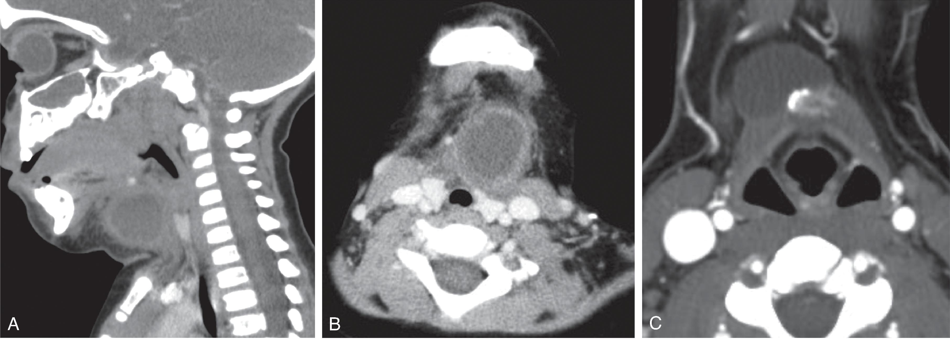 Fig. 14.2, Thyroglossal Duct Cyst: Uncommon Imaging Appearances.