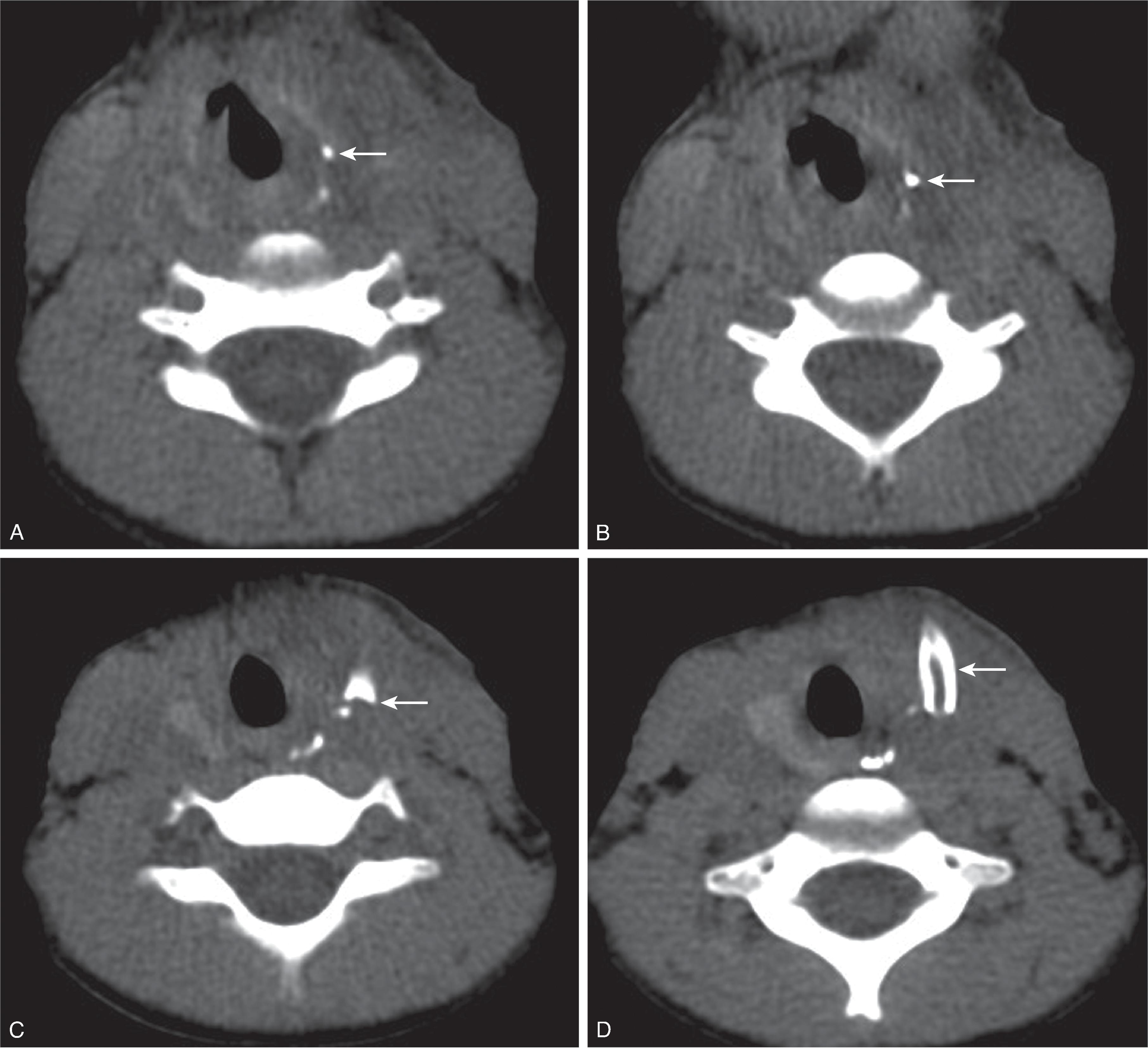 Fig. 14.11, Fourth Branchial Cleft Sinus Tract.