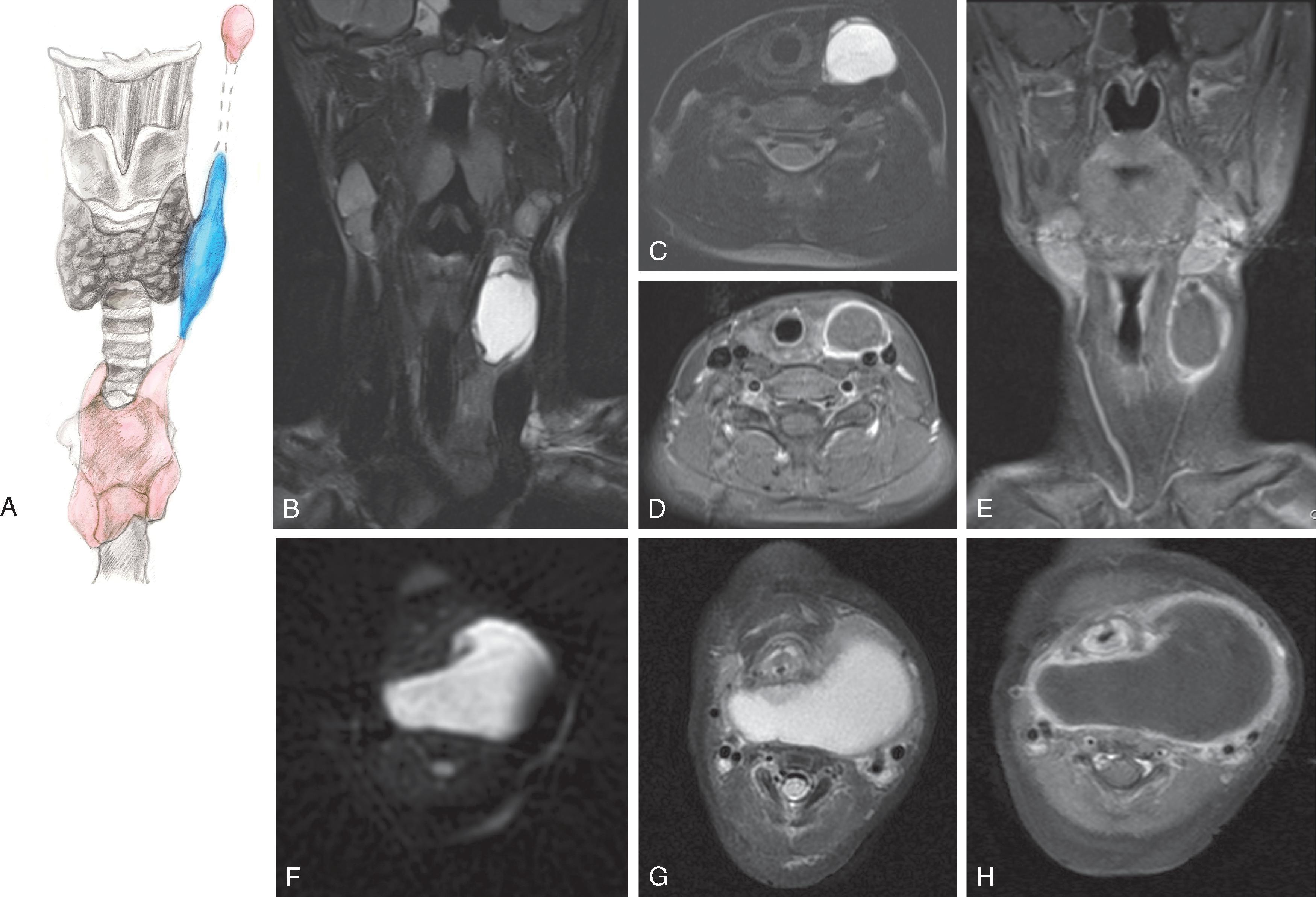 Fig. 14.13, Thymic Cyst.