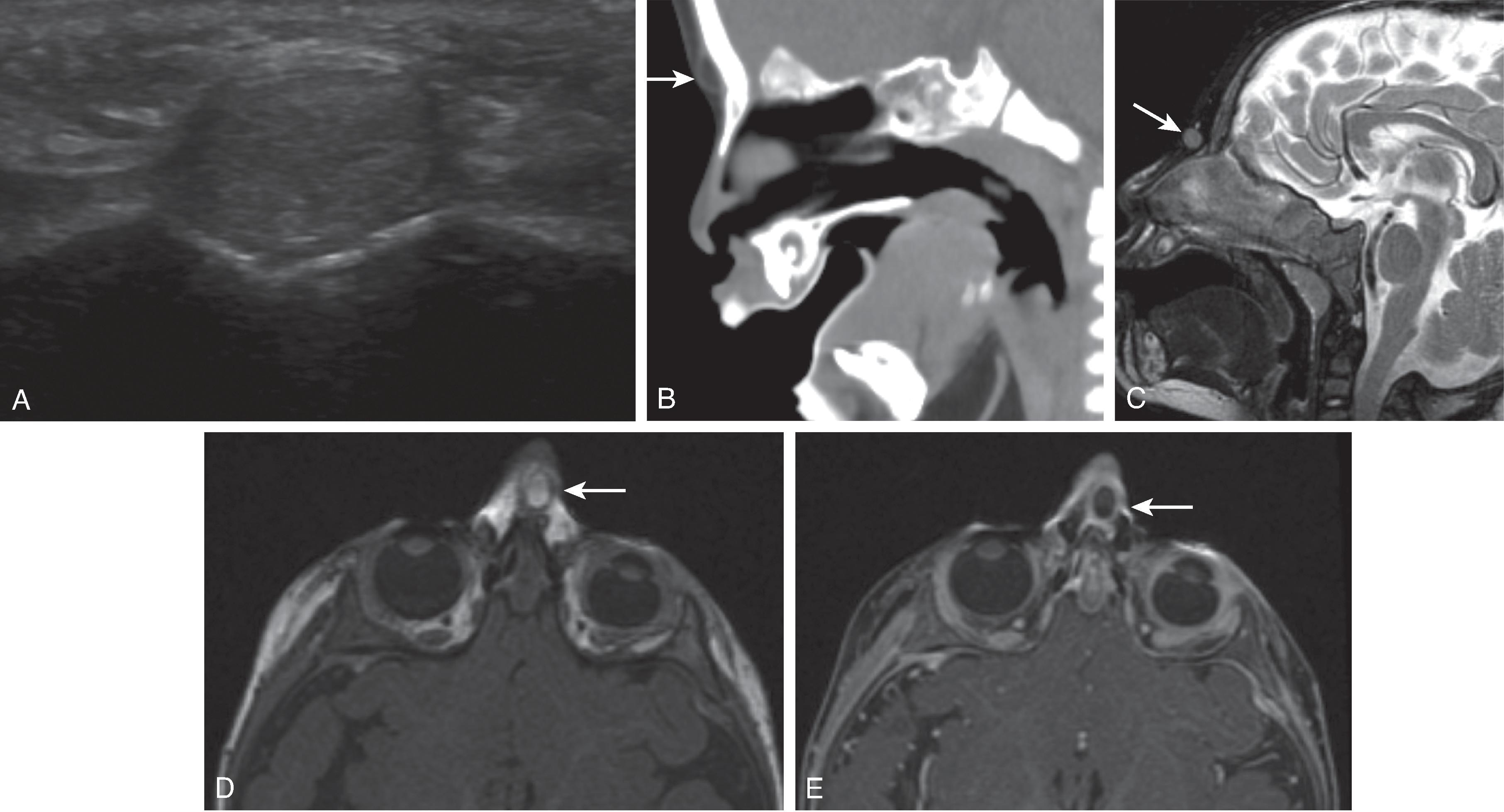 Fig. 14.15, Dermoid Cyst.