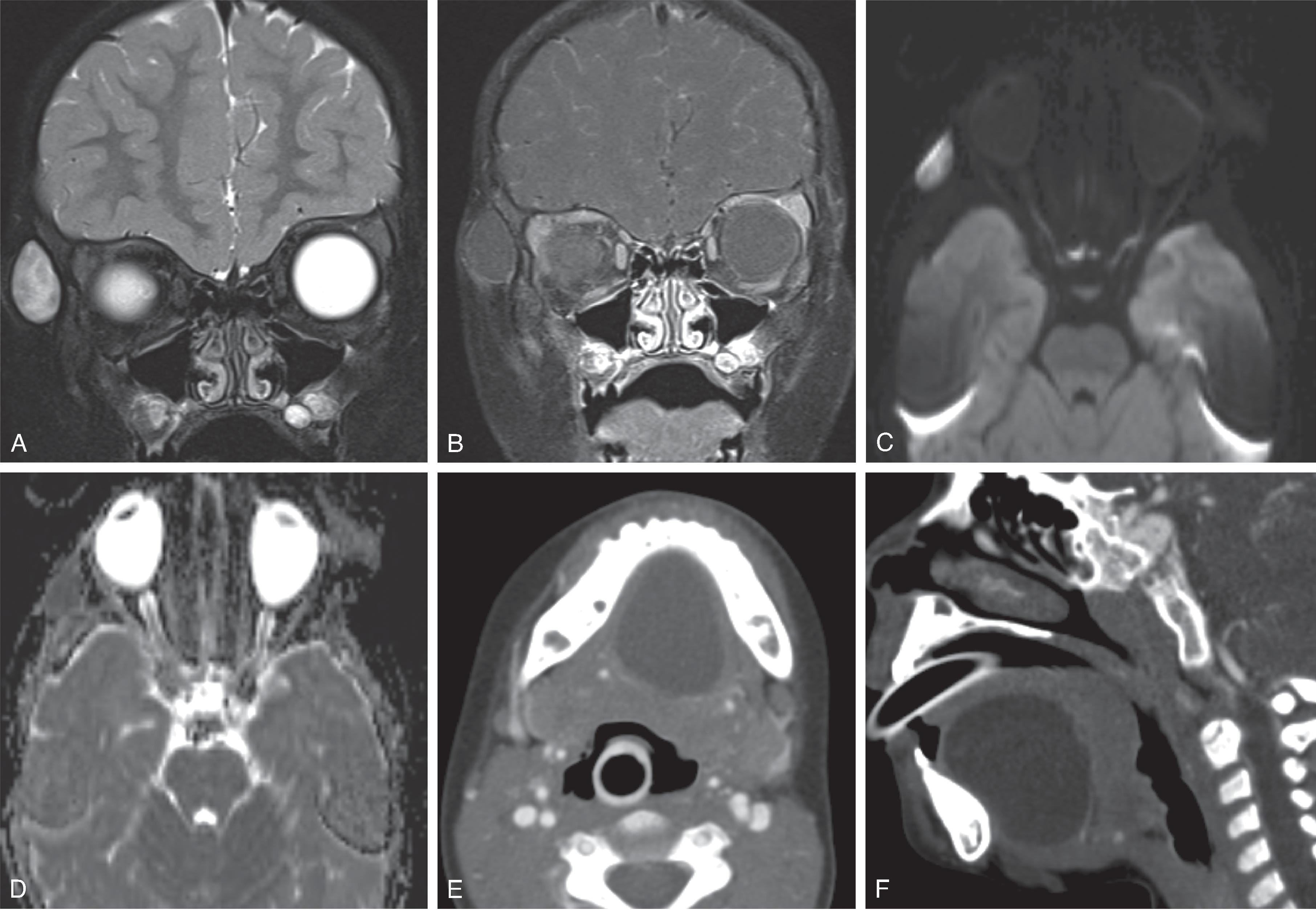 Fig. 14.17, Epidermoid Cyst.