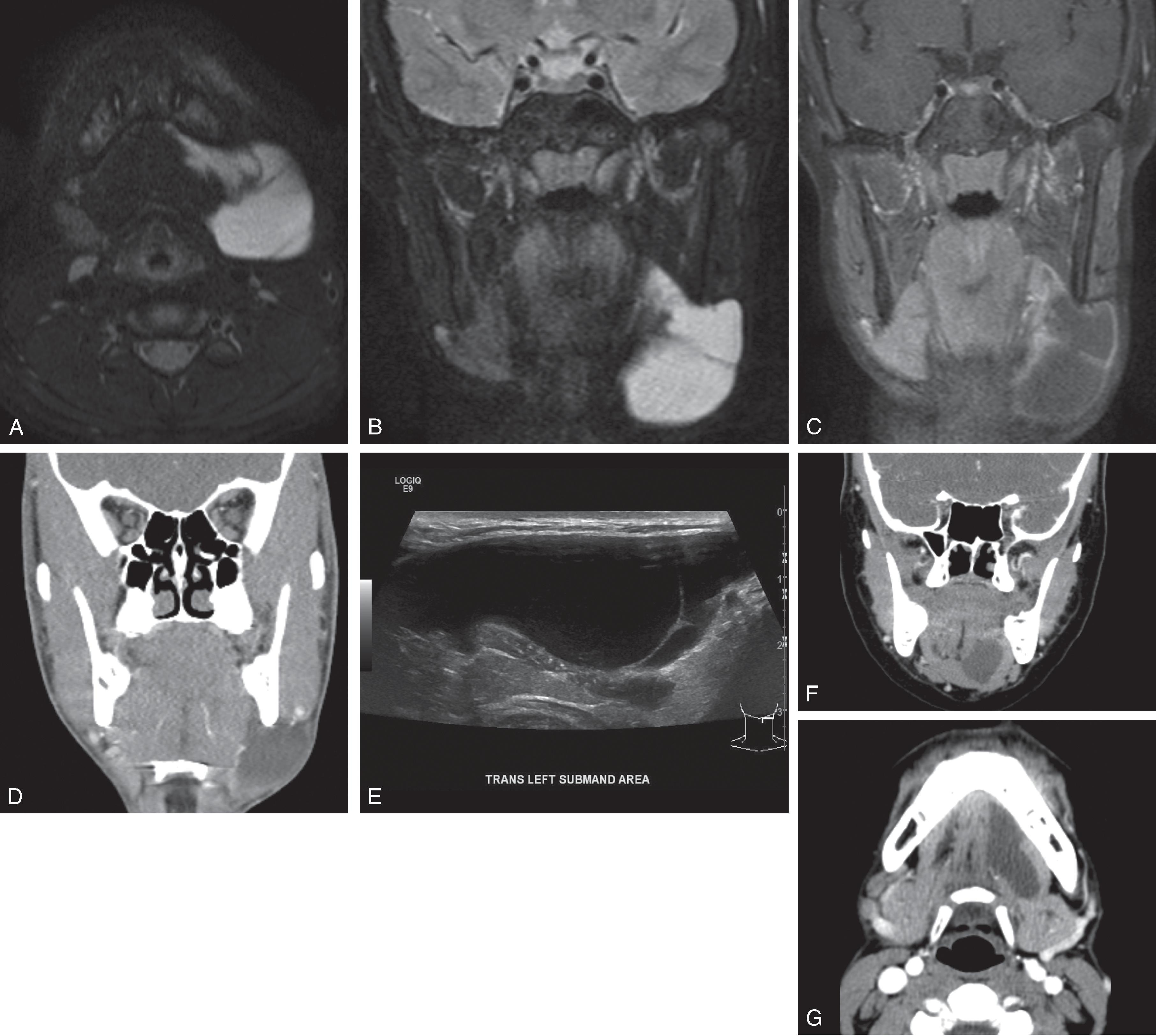 Fig. 14.18, Ranula.