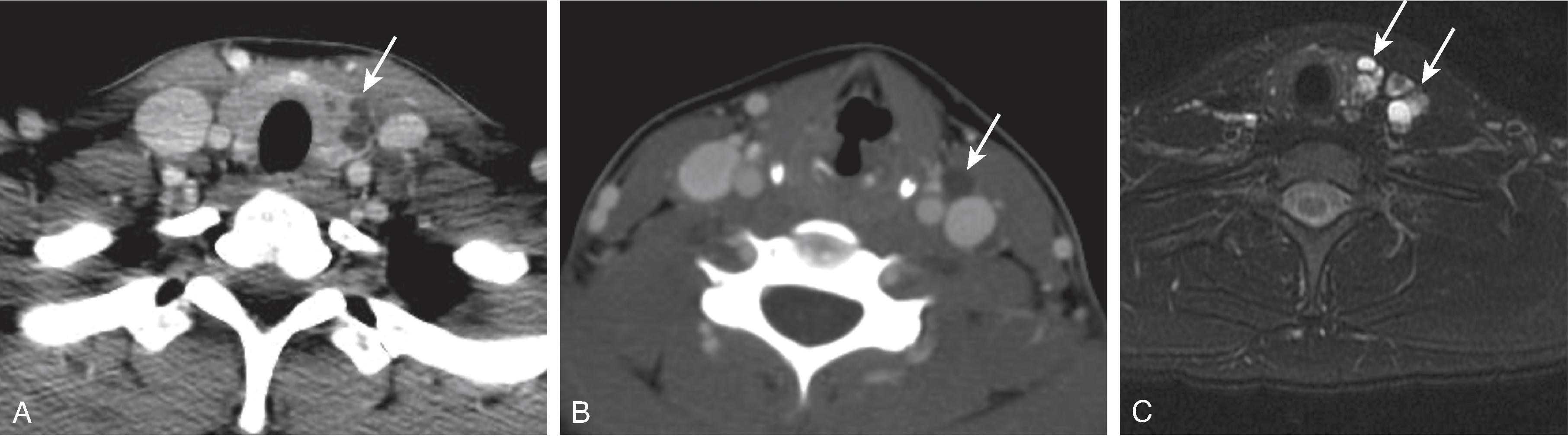 Fig. 14.19, Papillary Thyroid Cancer.