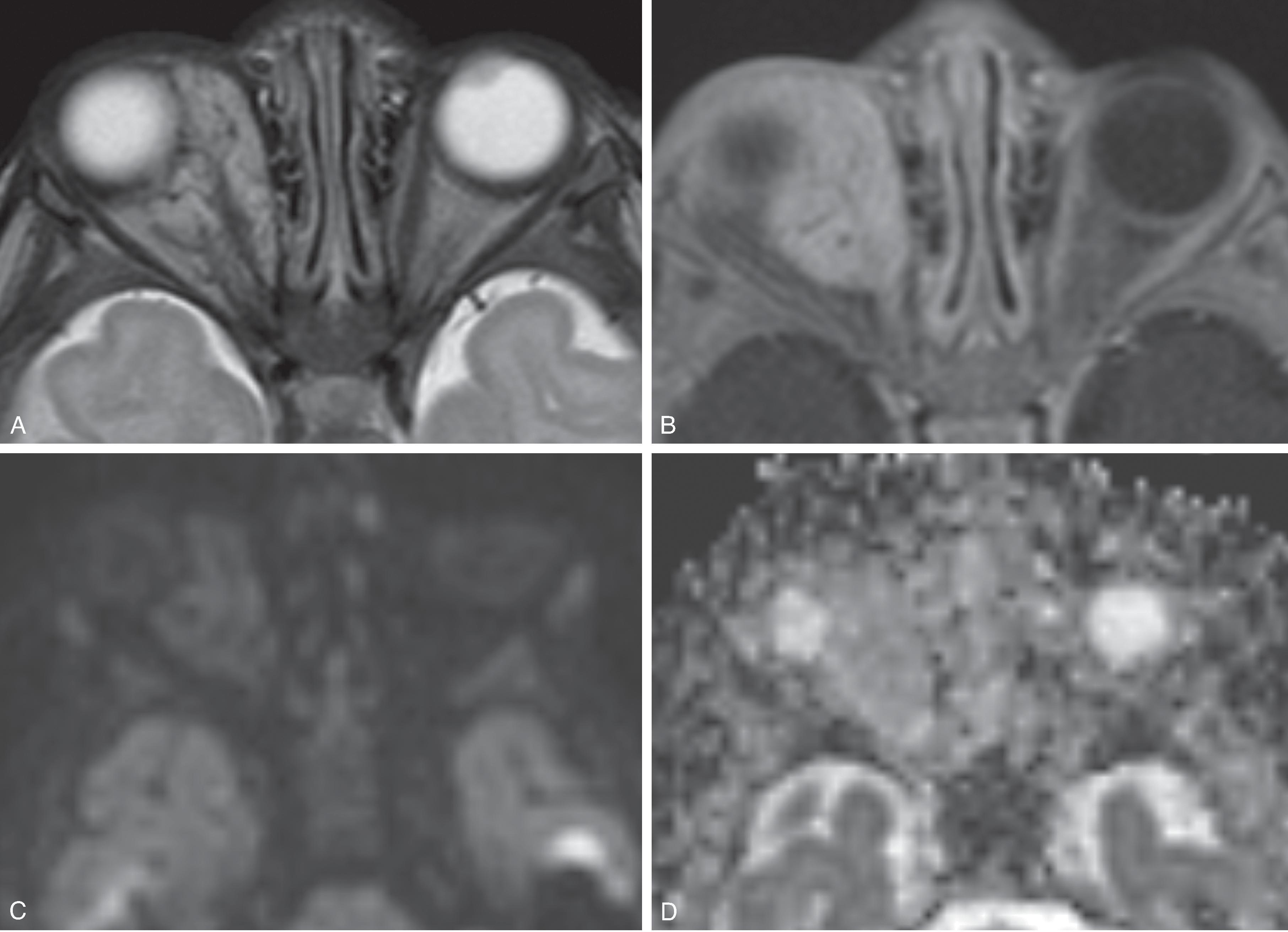 Fig. 14.20, Infantile Hemangioma.