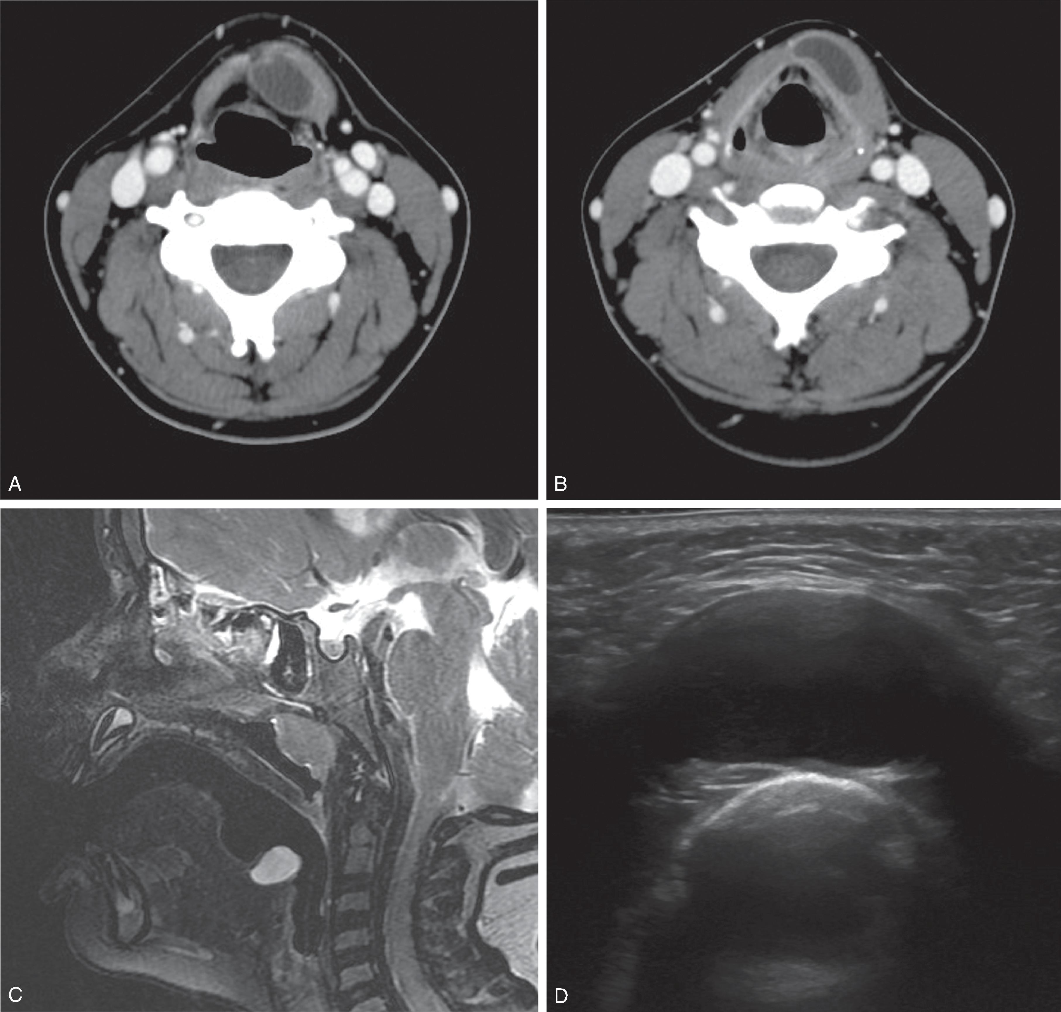 Fig. 14.1, Thyroglossal Duct Cyst: Typical Imaging Appearances.