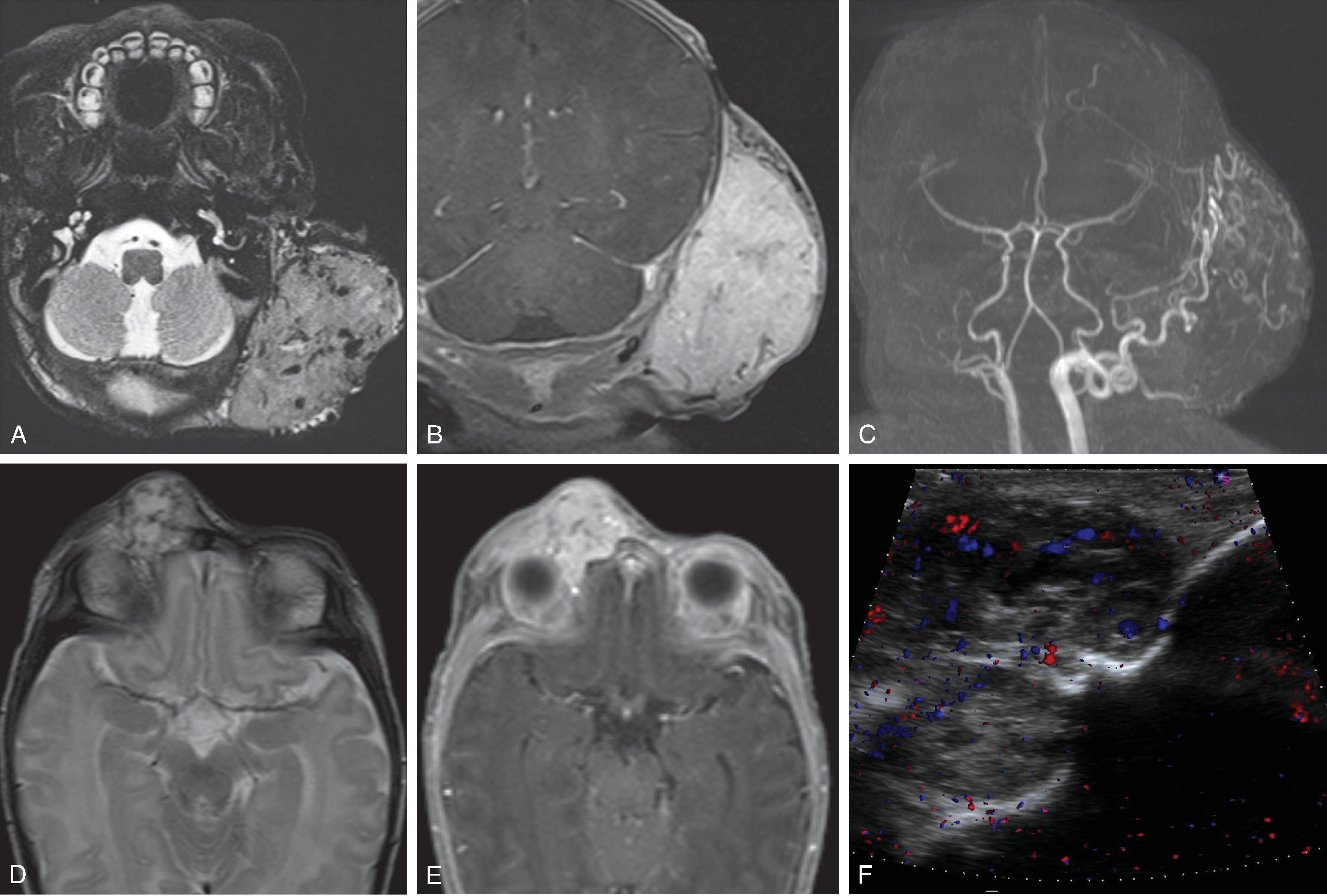 Fig. 14.21, Congenital Hemangioma.