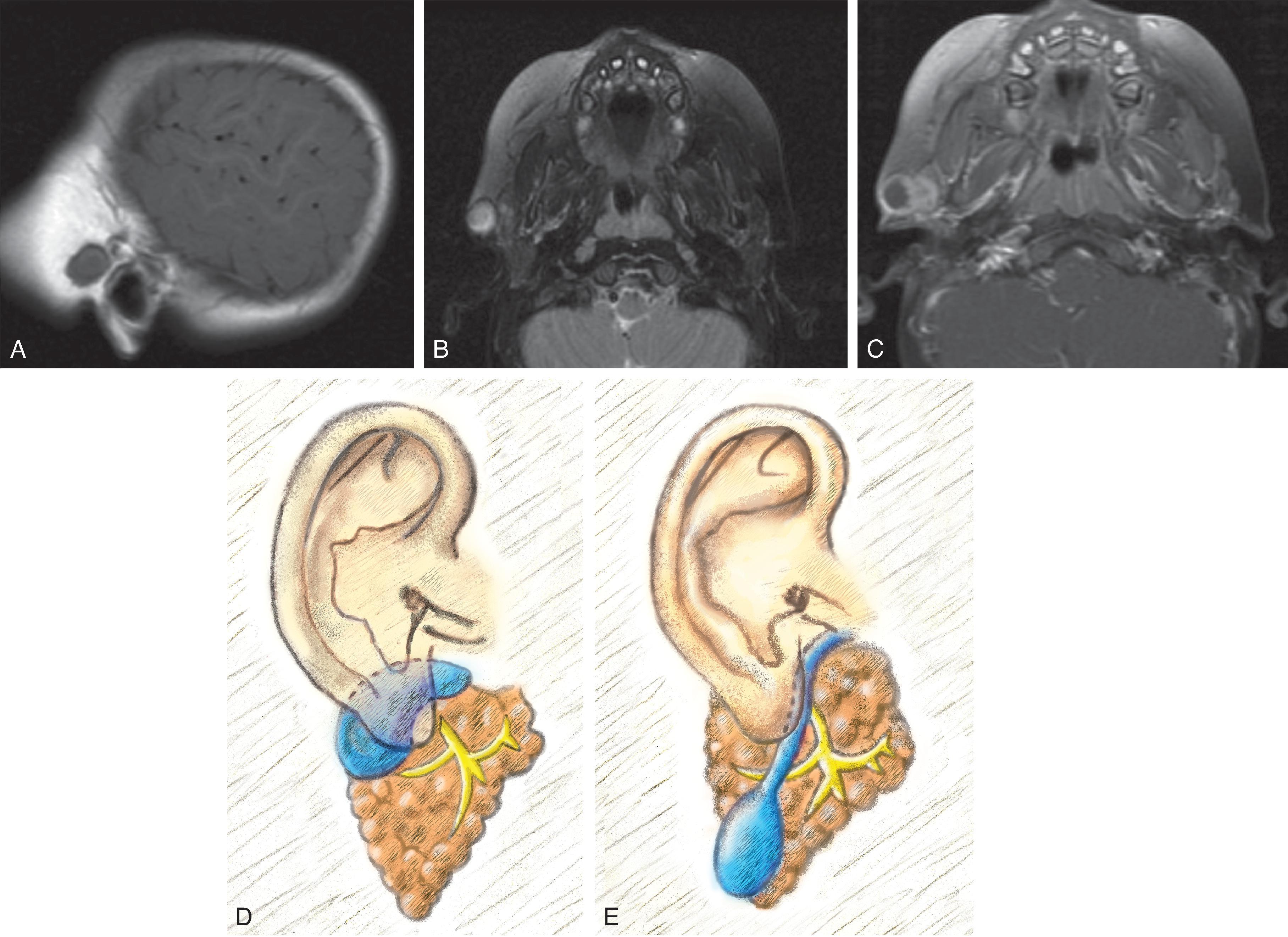 Fig. 14.4, First Branchial Cleft Cyst.