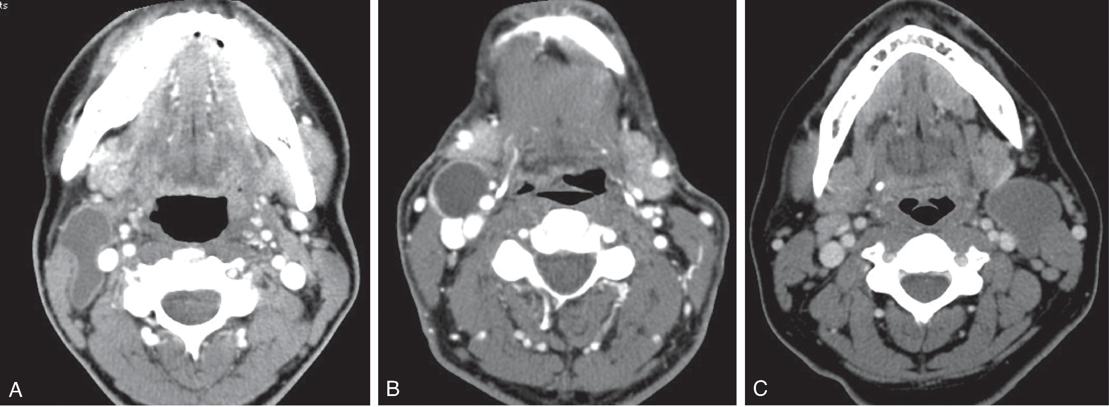 Fig. 14.6, Second Branchial Cleft Cyst: Typical Appearance.