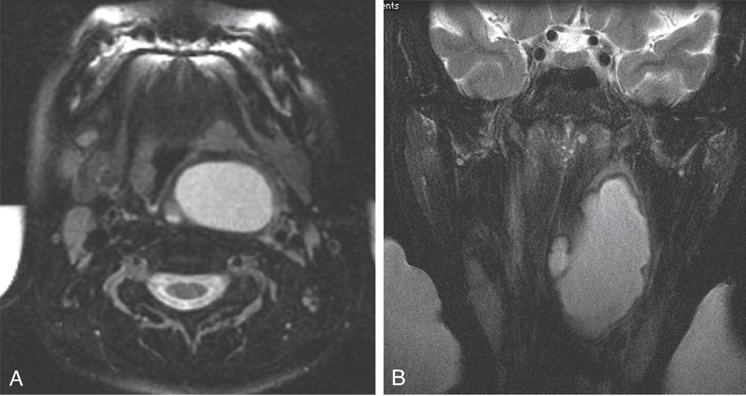 Fig. 14.7, Second Branchial Cleft Cyst: Atypical Appearance.