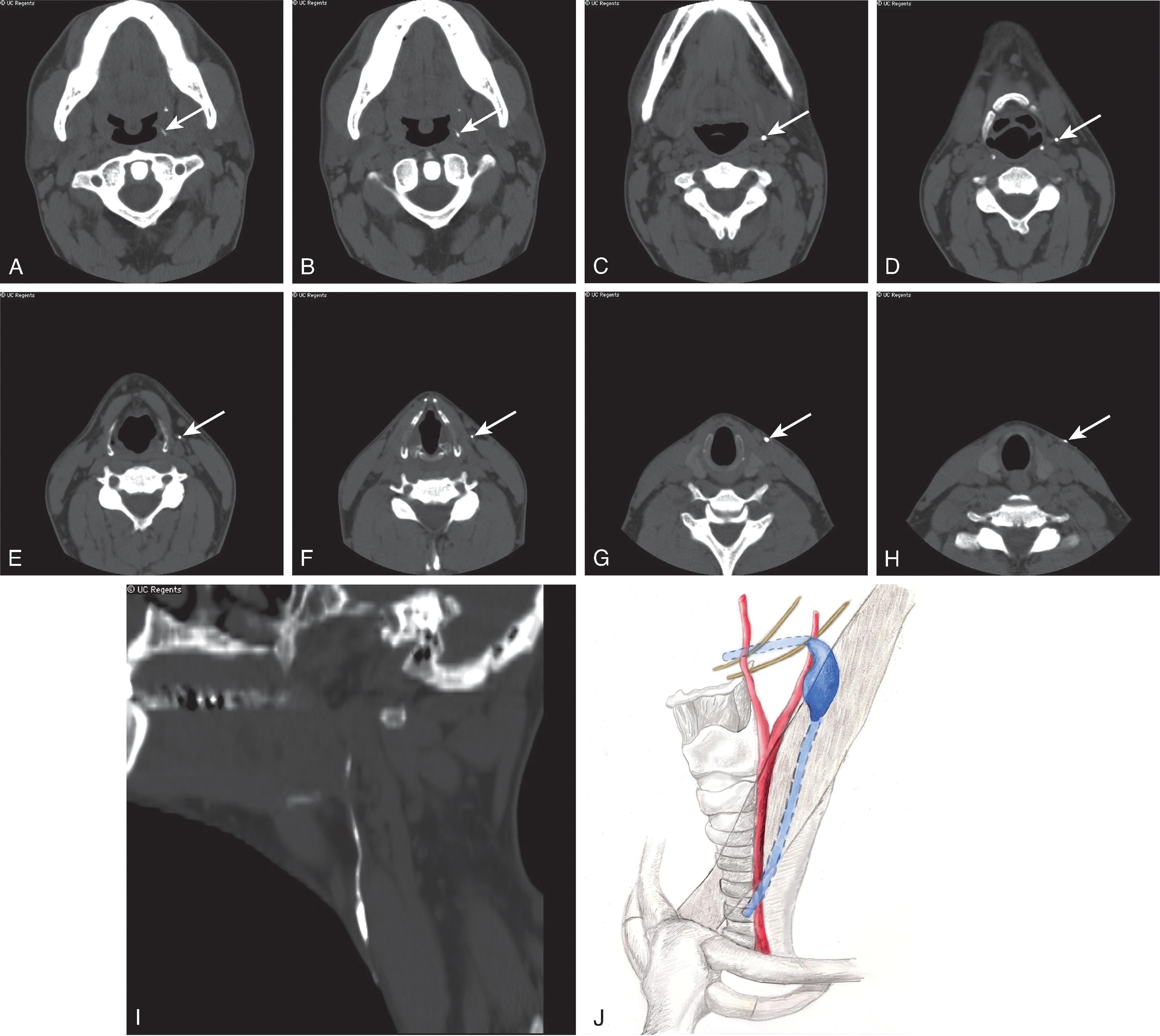 Fig. 14.8, Second Branchial Cleft Fistula.