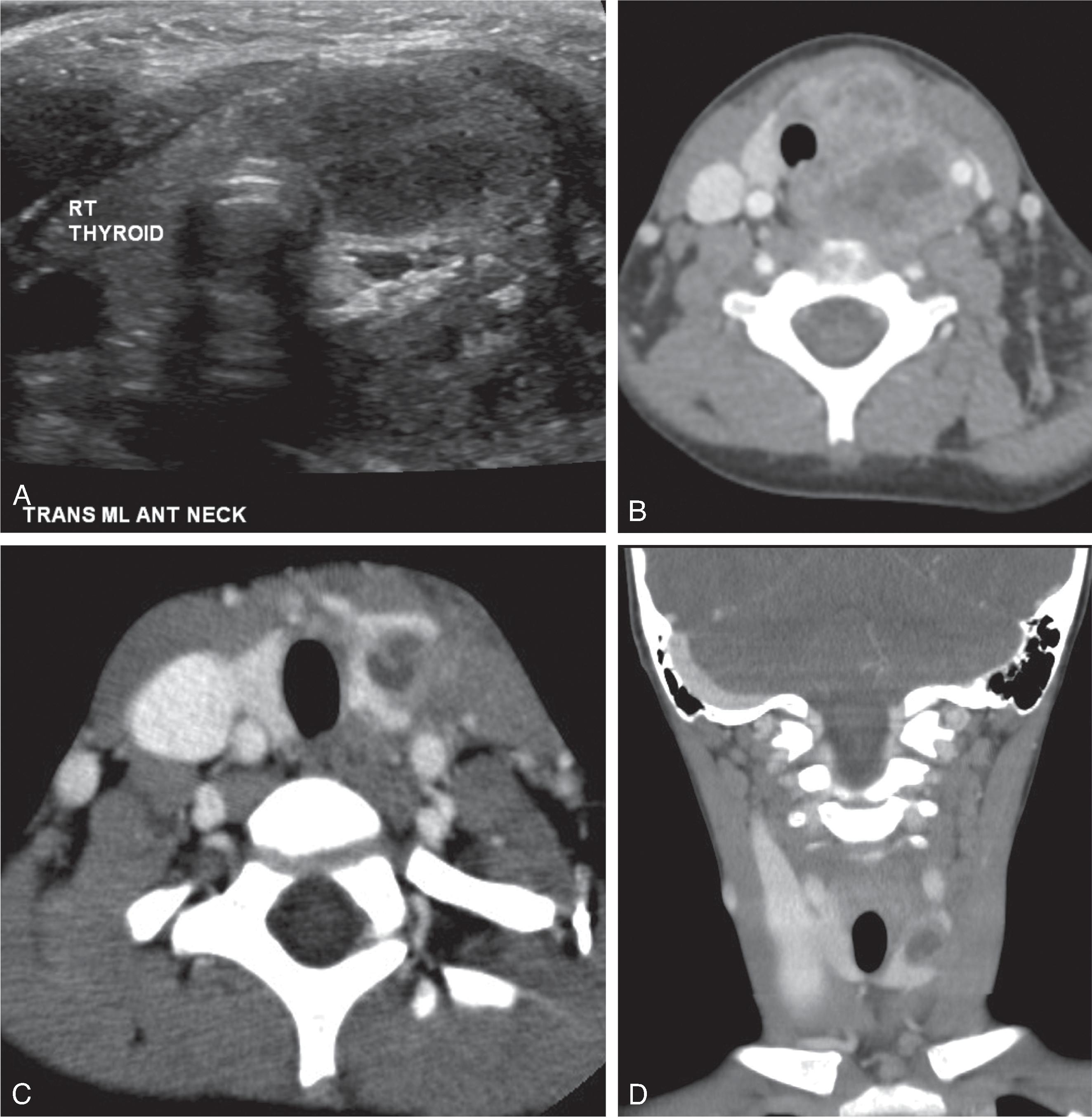 Fig. 14.10, Fourth Branchial Cleft Anomaly.