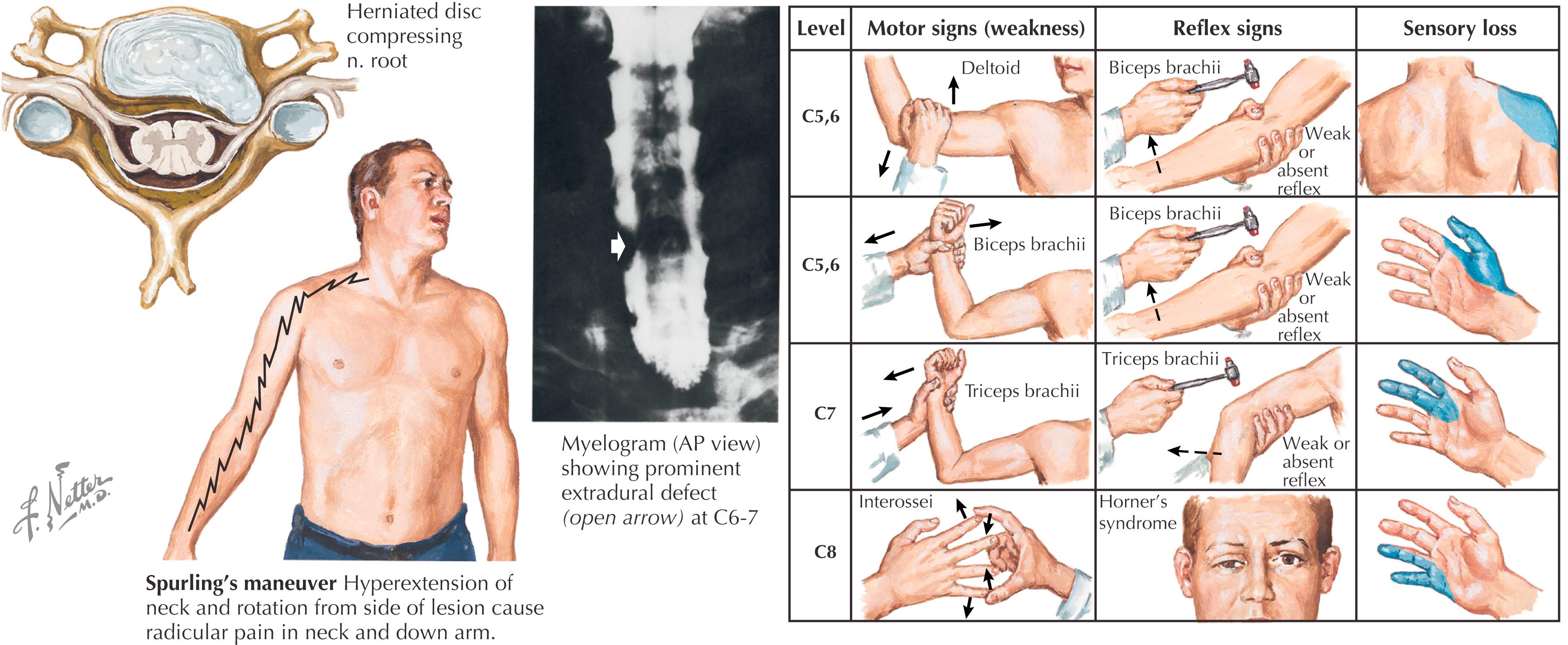 Figure 46.2, Cervical disc herniation: Clinical manifestations.