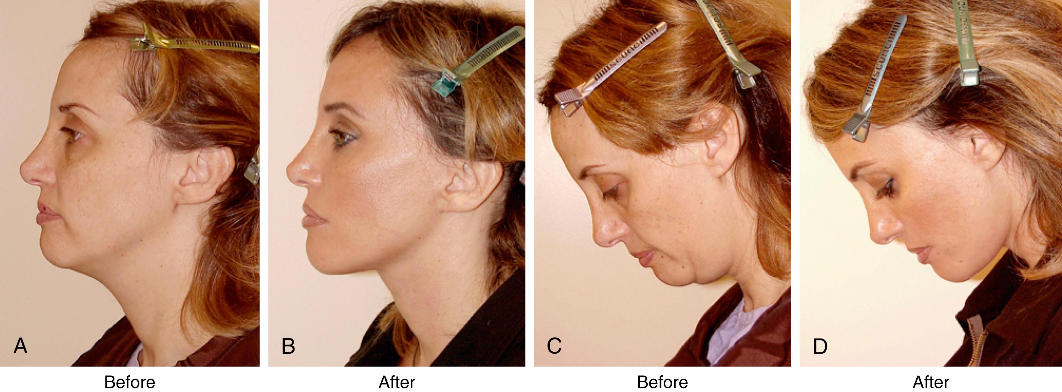 Fig. 67.1, Patient seen before and after neck lift. A good neckline conveys a sense of youth, health, fitness, confidence, vitality, decisiveness, sensuality, and beauty. The patient is seen (A,C) before and (B,D) 1 year and 3 months after facelift, temple lift, lower eyelid surgery, and facial fat injections.