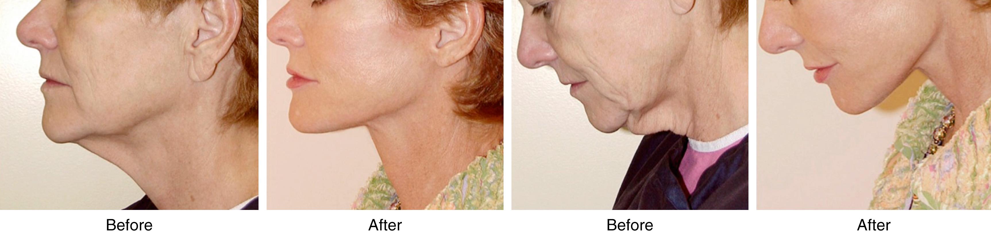 Fig. 67.11, Extended neck lift. Skin excision can be combined with treatment of the neck through the submental incision as an “extended” or “long-scar” neck lift, or as part of a facelift procedure. The patient had skin excised as part of the procedures, and an incision was made in the periauricular area.