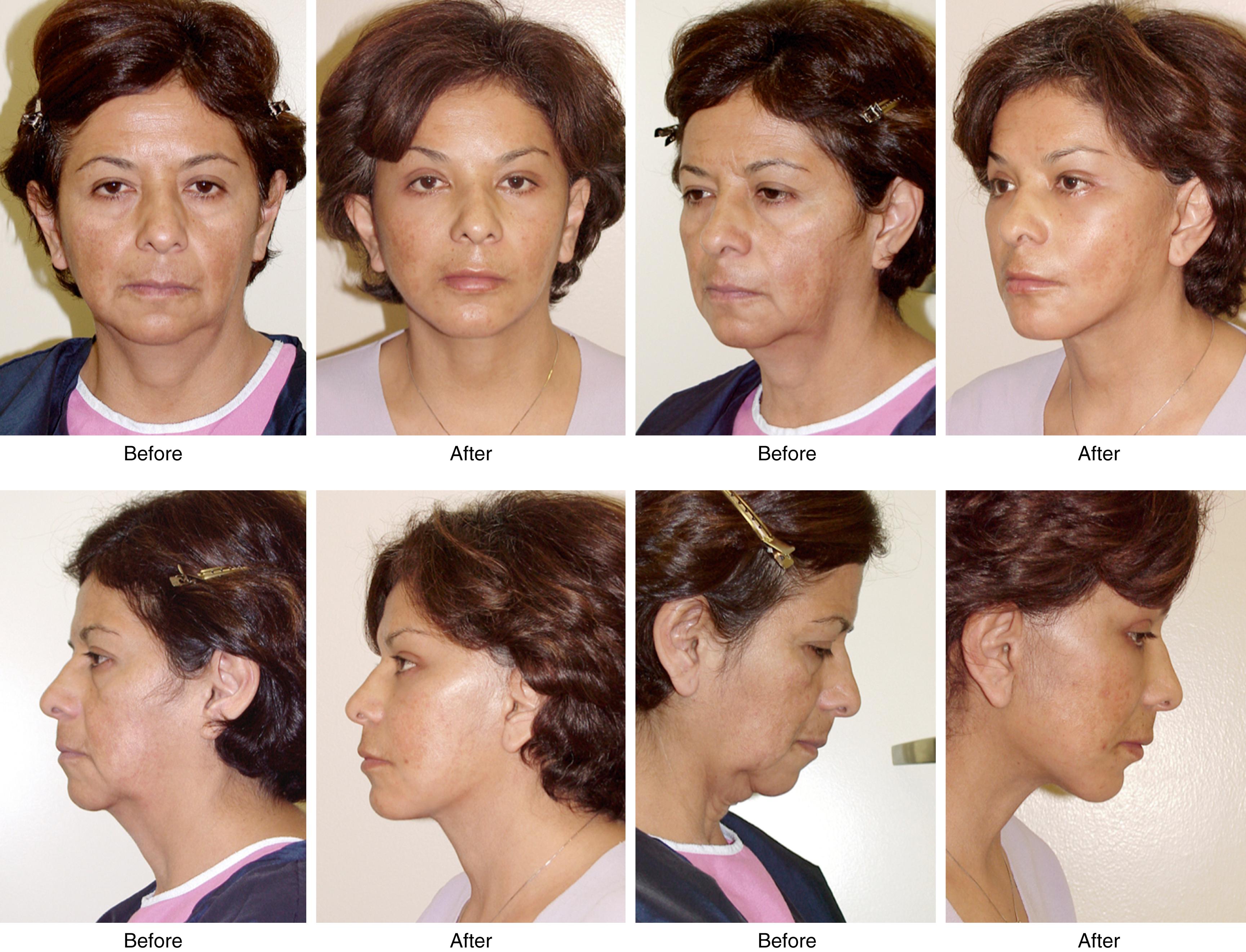 Fig. 67.12, Comprehensive rejuvenation of the face. Combining a neck lift with a facelift and related procedures is almost always the best approach to obtain a balanced, natural, and harmonious rejuvenation of the female face, although not all patients will recognize or accept this. This 55-year-old woman underwent facelift, neck lift, limited-incision (“short-scar”) forehead lift, upper and lower blepharoplasties, chin augmentation, and fat transfer to the lips and cheeks. Addressing all regions of the face has produced a natural balanced outcome, and a far better result than neck lift alone (see also Fig. 67.1 ).