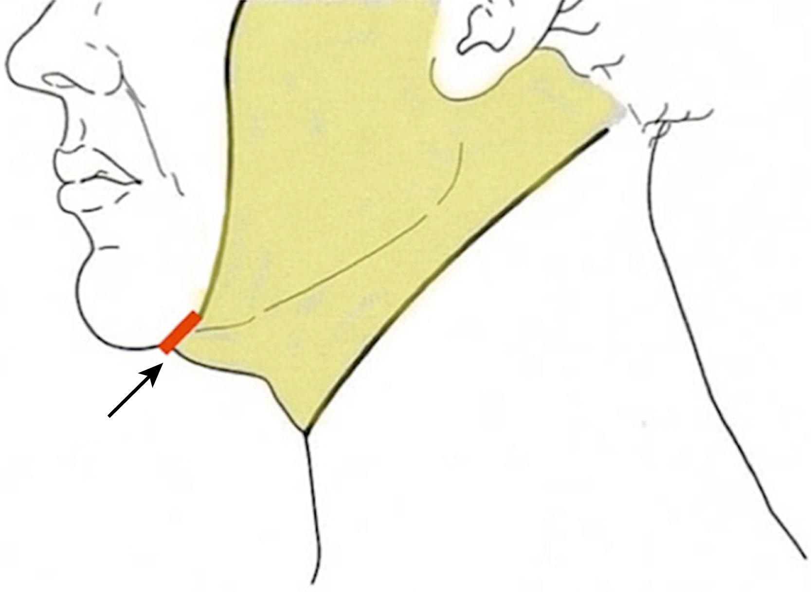 Fig. 67.13, Traditional, but incorrect plan for the submental incision. The incision should not be placed directly along the submental crease ( arrow ) as this will reinforce the submental retaining ligaments and accentuate the “double chin” appearance. Note that typical plan of skin undermining (yellow area) also promotes a “double chin” appearance because the crease is not undermined, retaining ligaments are not released, and the fat of the chin and the neck cannot be readily blended to create a smooth transition between them.