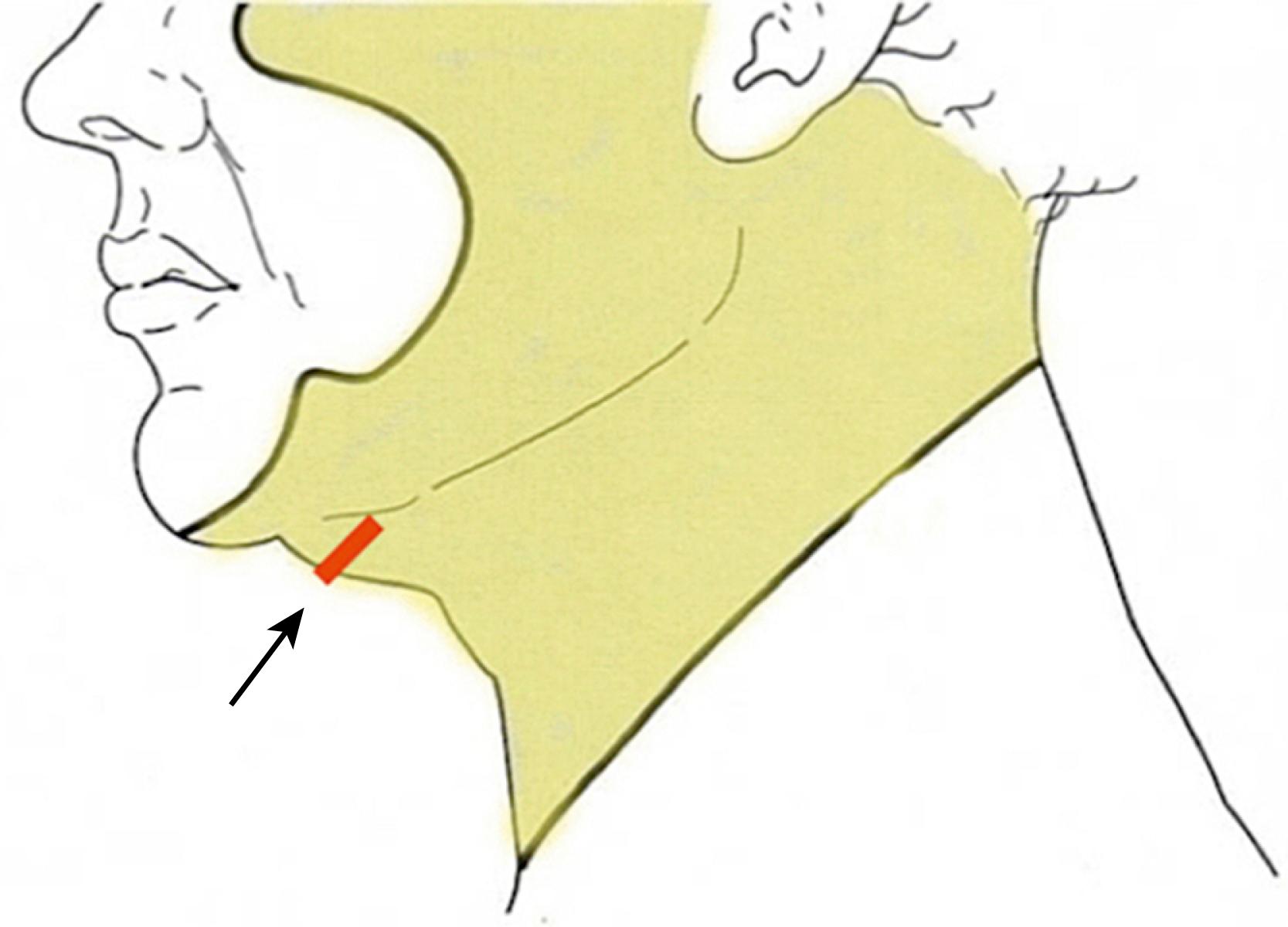 Fig. 67.14, Correct location for the submental incision. Placing the submental incision 1.5 cm posterior to the submental crease ( arrow ) prevents accentuation of the “double chin” and “witch’s chin” deformities and provides for easier dissection and suturing in the anterior neck (compare with Fig. 67.10 ). Note that this incision plan allows the submental crease to be undermined and submental retaining ligaments to be released, and the fat of the chin pad and neck to be blended to create a smooth transition between them (see Fig. 67.15 ).