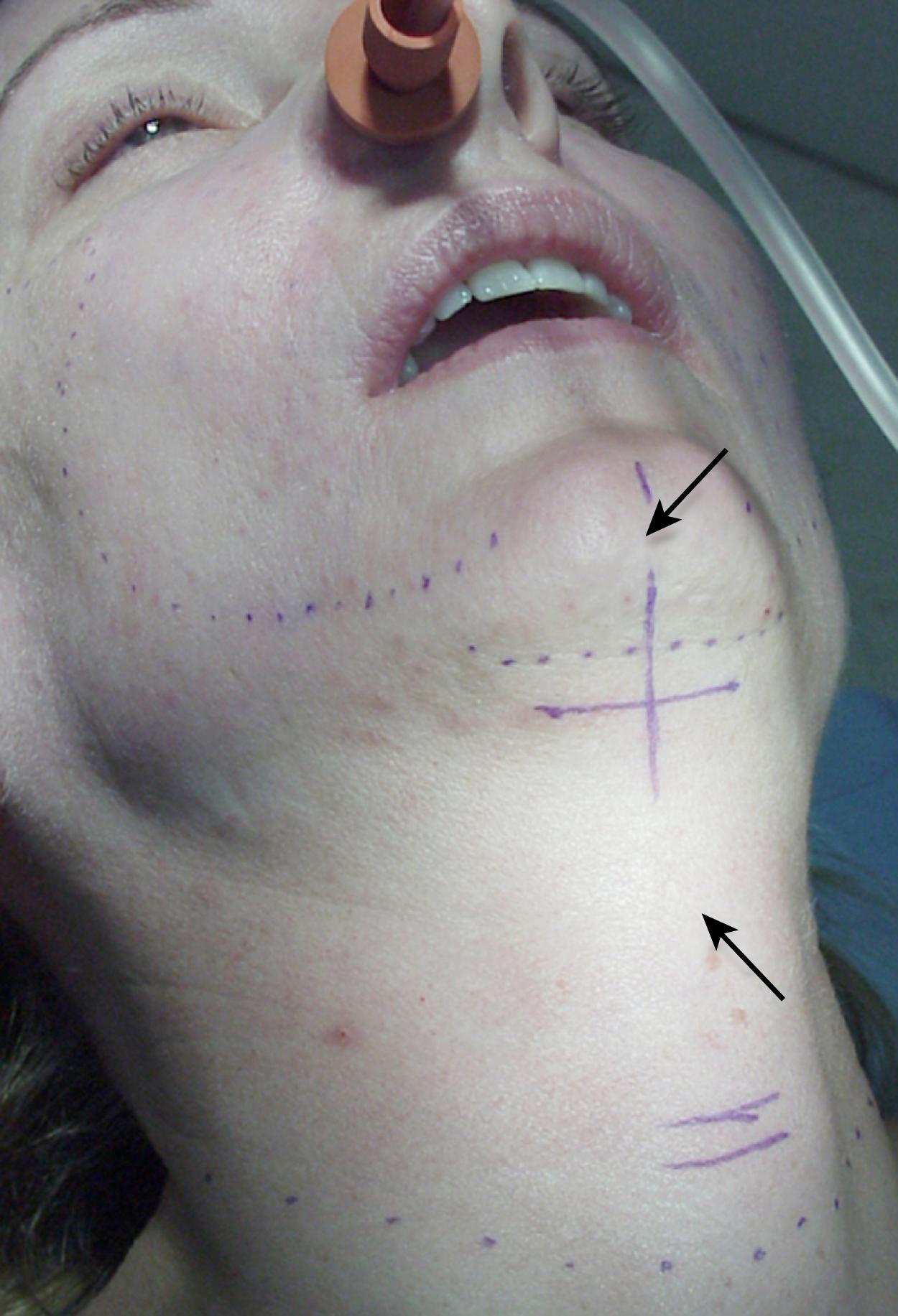 Fig. 67.16, Plan for the submental incision. The submental portion of the facelift incision ( solid line ) should be placed posterior to the submental crease ( dotted line ), approximately one-half the distance between the mentum and hyoid ( arrows ). Usually this corresponds to a point about 1.5 cm posterior to the submental crease.