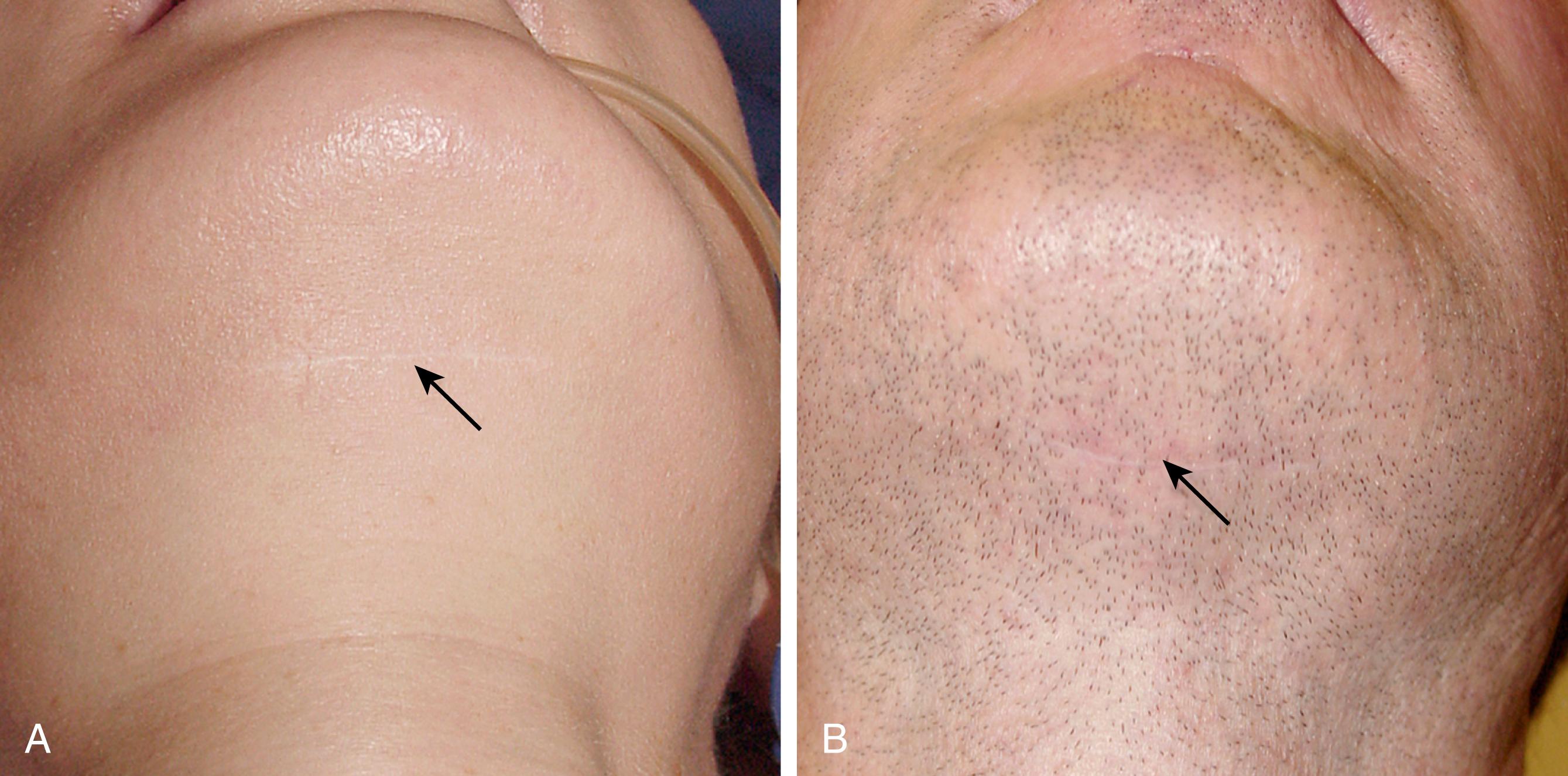 Fig. 67.17, Healed submental incisions. (A,B) Placement of the submental incision posterior to the submental crease will still result in an inconspicuous, well-concealed scar and simultaneously provide better access and exposure when working in the deep layers of the neck.