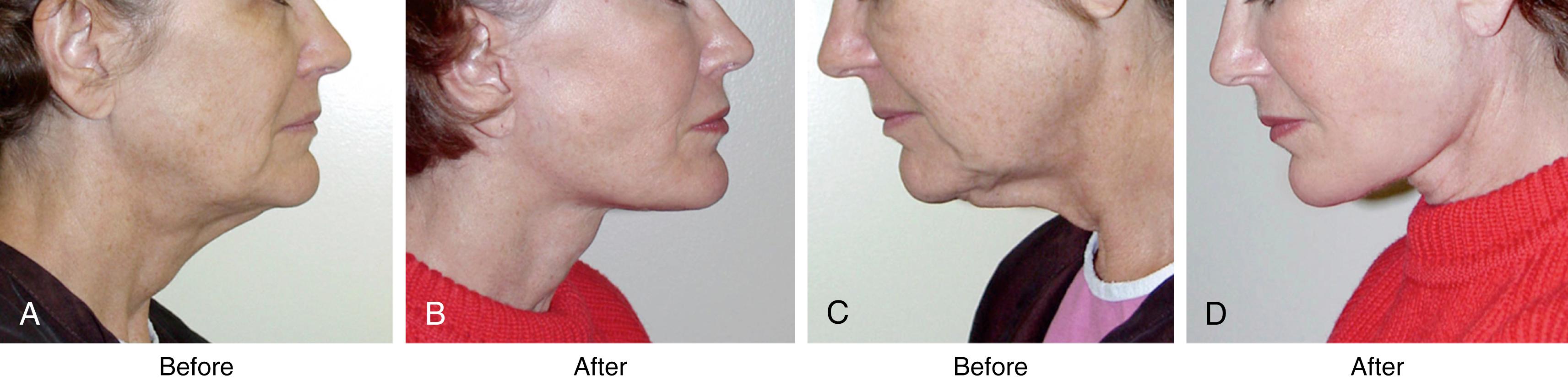 Fig. 67.2, Patient seen before and after neck lift. It is not enough to perform submental liposuction and tighten the skin in most patients. Such an approach ignores anatomical problems present in many patients seeking neck improvement . (A,C) A careful evaluation shows the patient preoperatively to be troubled by platysmal laxity, platysma bands, excess subplatysmal fat, large submandibular glands, digastric muscle hypertrophy. (B,D) Removing subcutaneous fat and tightening skin over these problems does not correct them, and cannot produce the type of improvement shown.