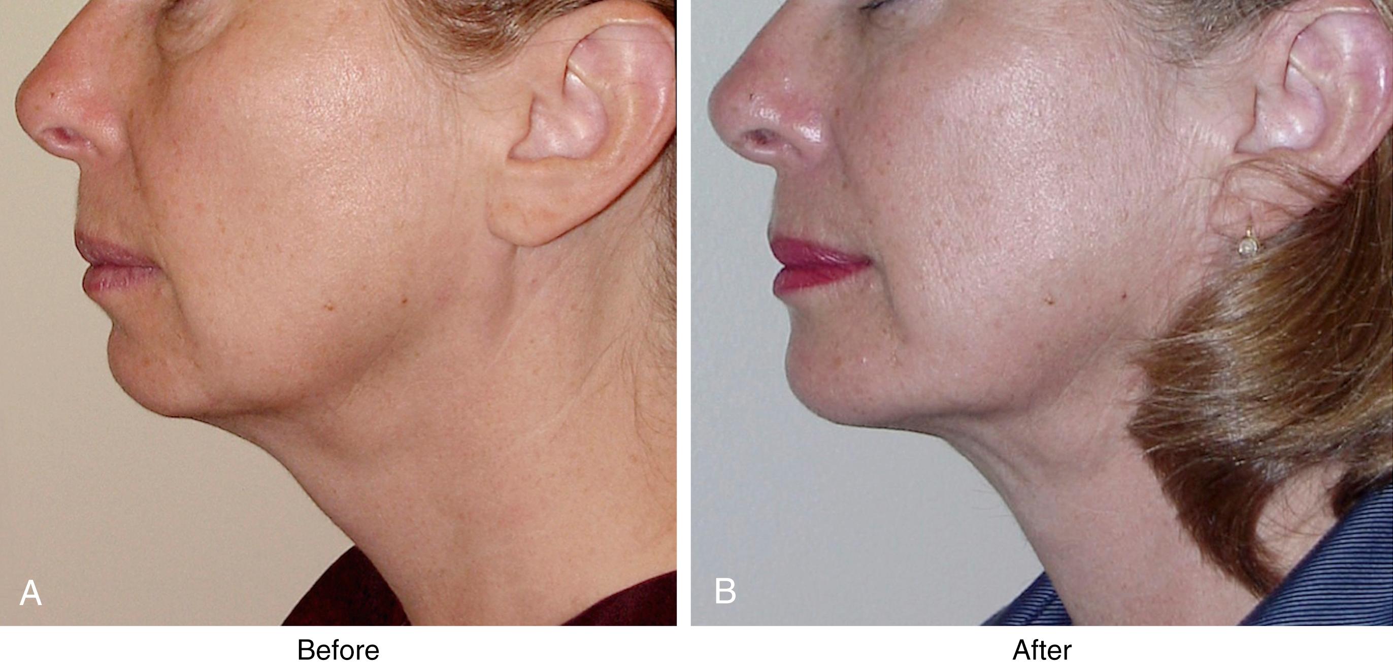 Fig. 67.3, (A,B) Typical outcome seen with submental liposuction. Submental liposuction is an incomplete solution to neck problems for most patients as it falsely assumes that poor neck contour is solely the result of the accumulation of subcutaneous fat, and it does not address platysma laxity and other deep layer problems which usually play a much larger role in the aging neck. Note that the large submandibular salivary gland is still present, platysma laxity has not been corrected, and aggressive fat removal has made platysma bands more obvious.