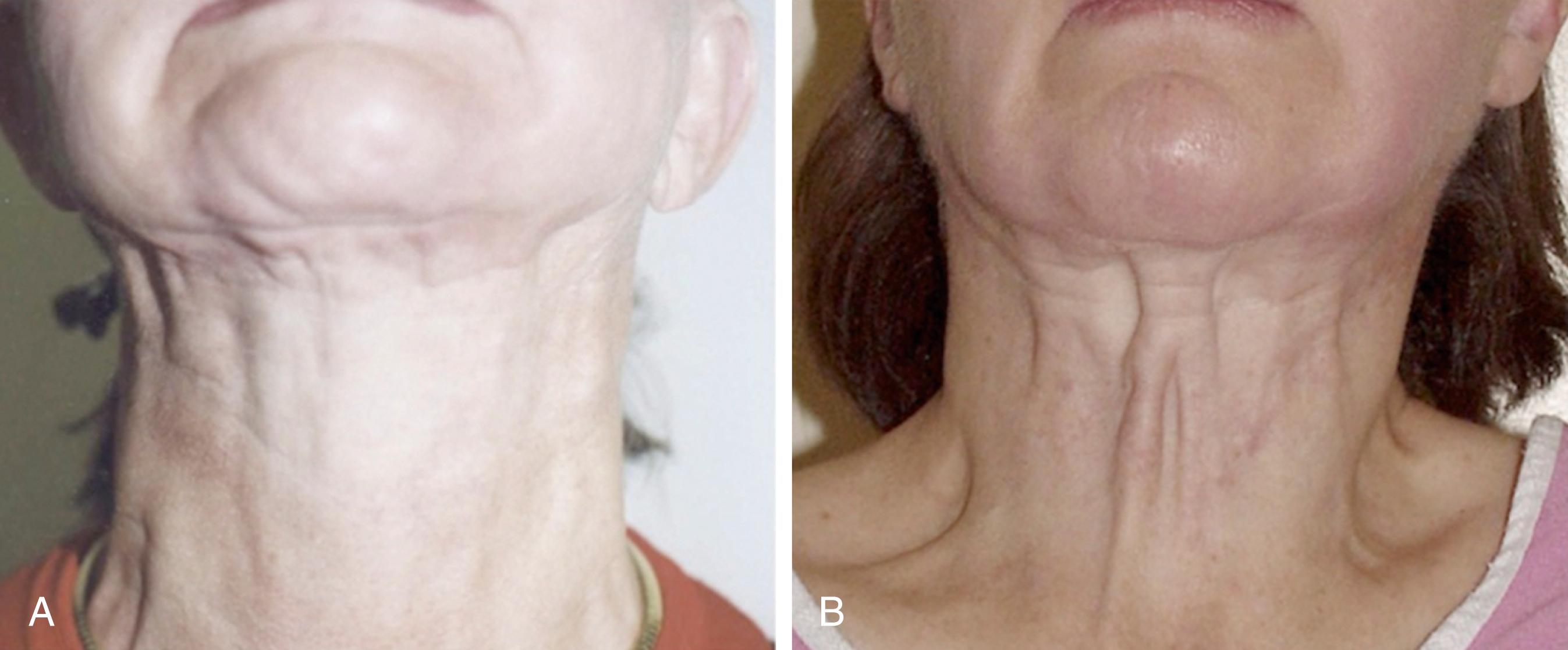 Fig. 67.4, Overexcision of subcutaneous fat with liposuction. (A) The patient has had aggressive “small cannula micro-liposculpture” by an unknown surgeon, which resulted in too much fat being removed. The neck and submental region are irregular, unnatural, and unattractive. (B) A different patient has had “laser liposuction” performed by an unknown surgeon. Inappropriate overresection of fat has resulted in harsh and unnatural contours along with unattractive exposure of platysmal bands.