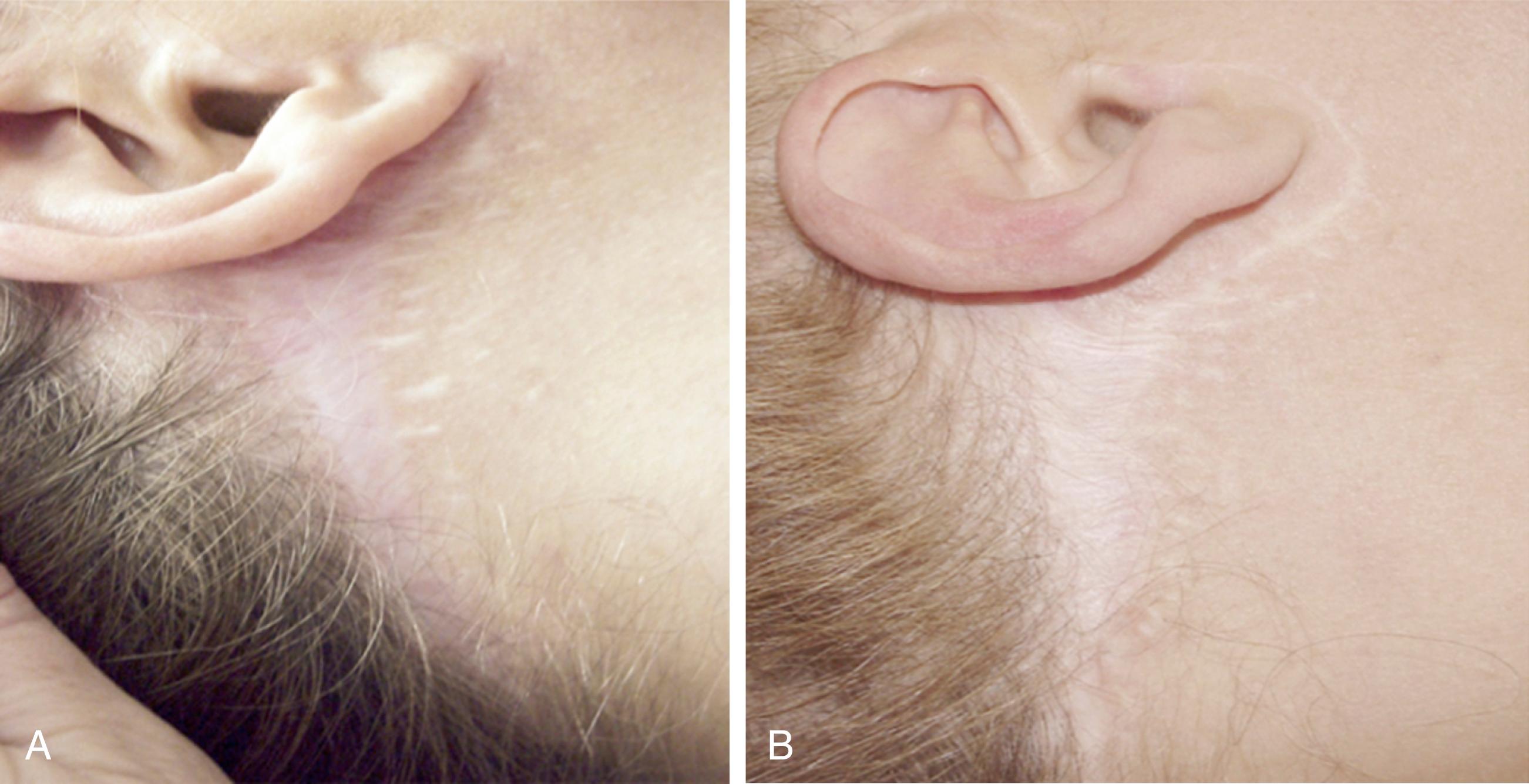 Fig. 67.5, (A,B) Overexcision of postauricular skin. It is a common error to attempt to lift the neck by tightening neck skin. It is not possible, however, to create a sustained improvement in neck contour in this manner and ill-conceived over-tightening of neck skin will result in wide post-auricular scars (and if the incision is planned poorly, hairline displacement). Neck contour is properly created by modification of deep layer structures and only skin that is truly redundant should be removed. In some case no skin at all needs be removed (see Fig. 67.6 ).