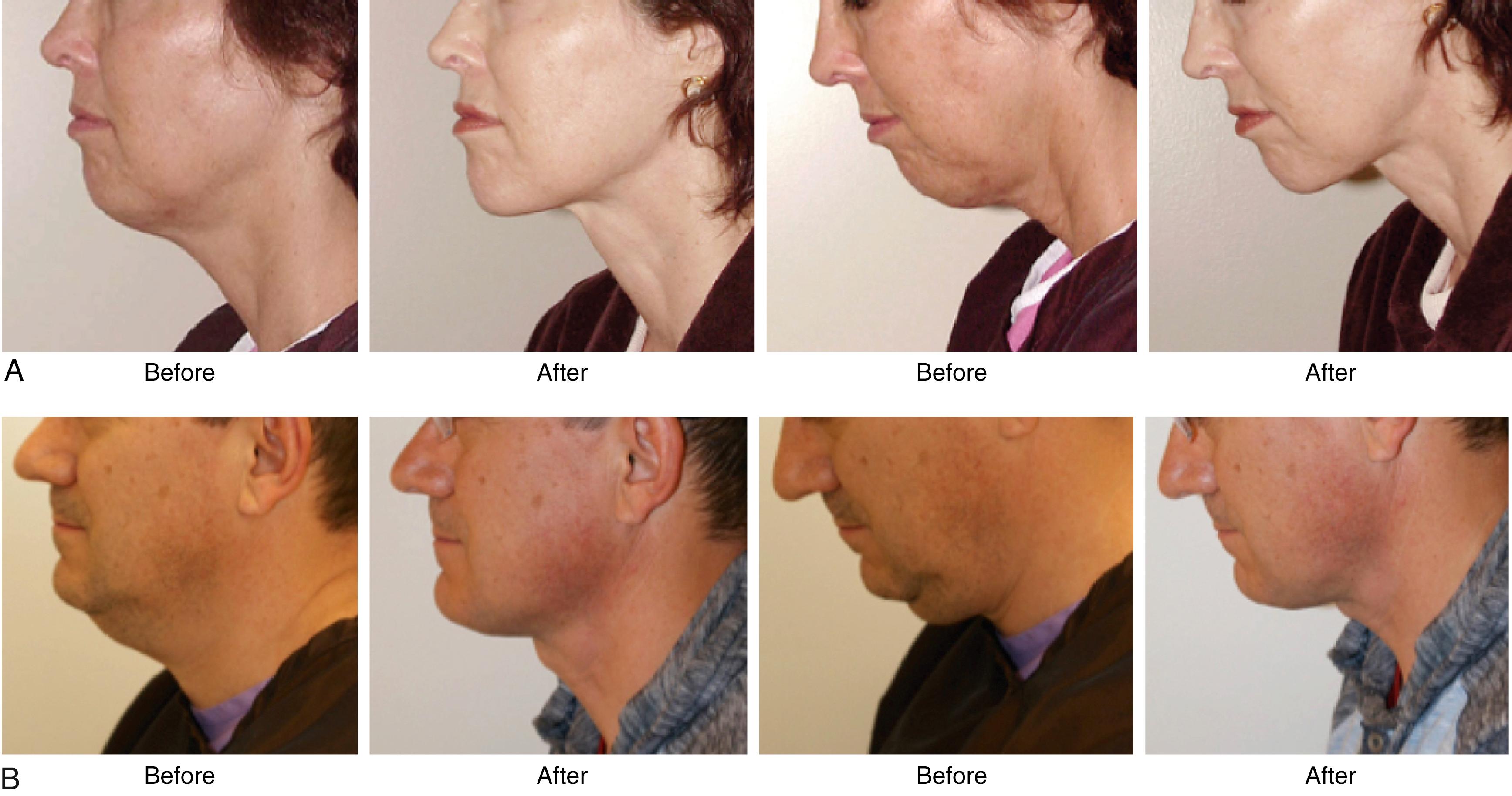 Fig. 67.6, Neck lift with a submental incision only. Although submental liposuction alone will rarely produce optimal neck improvement, a neck lift performed through a submental incision without any removal of skin can create attractive cervical contour in many patients. These patients had their procedures performed through a submental incision only. No incisions were made in the periauricular areas and there are no periauricular scars. Improvement in neck contour was achieved by modifying and reducing subplatysmal structures, not by tightening the skin, removing subcutaneous fat, or by tightening the platysma.