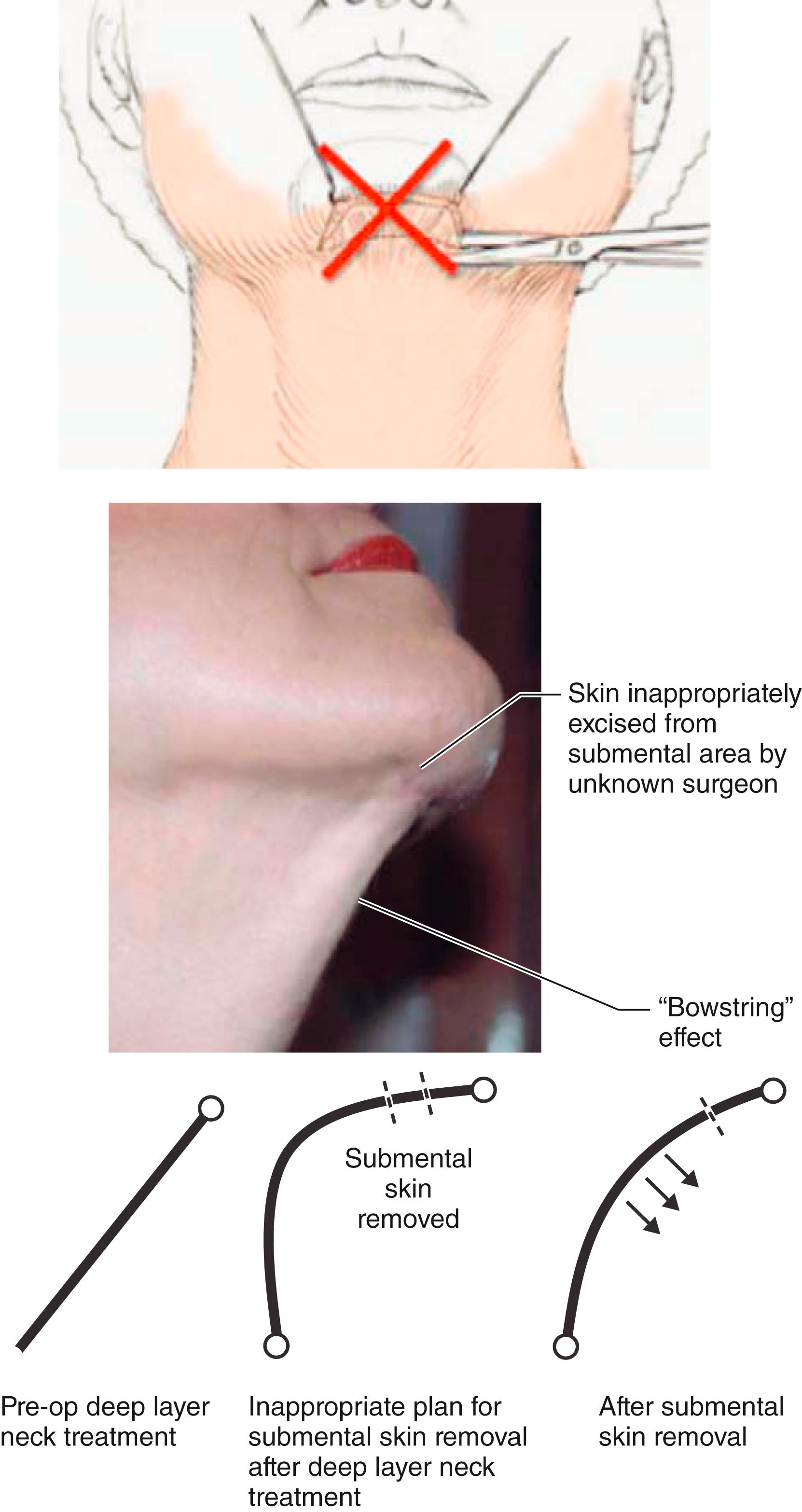 Fig. 67.8, Incorrect excision of skin from the submental incision and “bowstring effect.” Once it is recognized that increased neck surface area and deepening the cervicomental angle is created by treatment of subplatysmal neck problems it becomes clear why it is counterproductive to excise any skin from the submental incision as this can create a “bowstring” effect and actually blunt the cervicomental angle . This maneuver will also result in objectionable “dog-ears” at each end of the incision that spoil cervicosubmental contour. If skin excision is necessary it is more practically, effectively, and logically removed from the postauricular area.