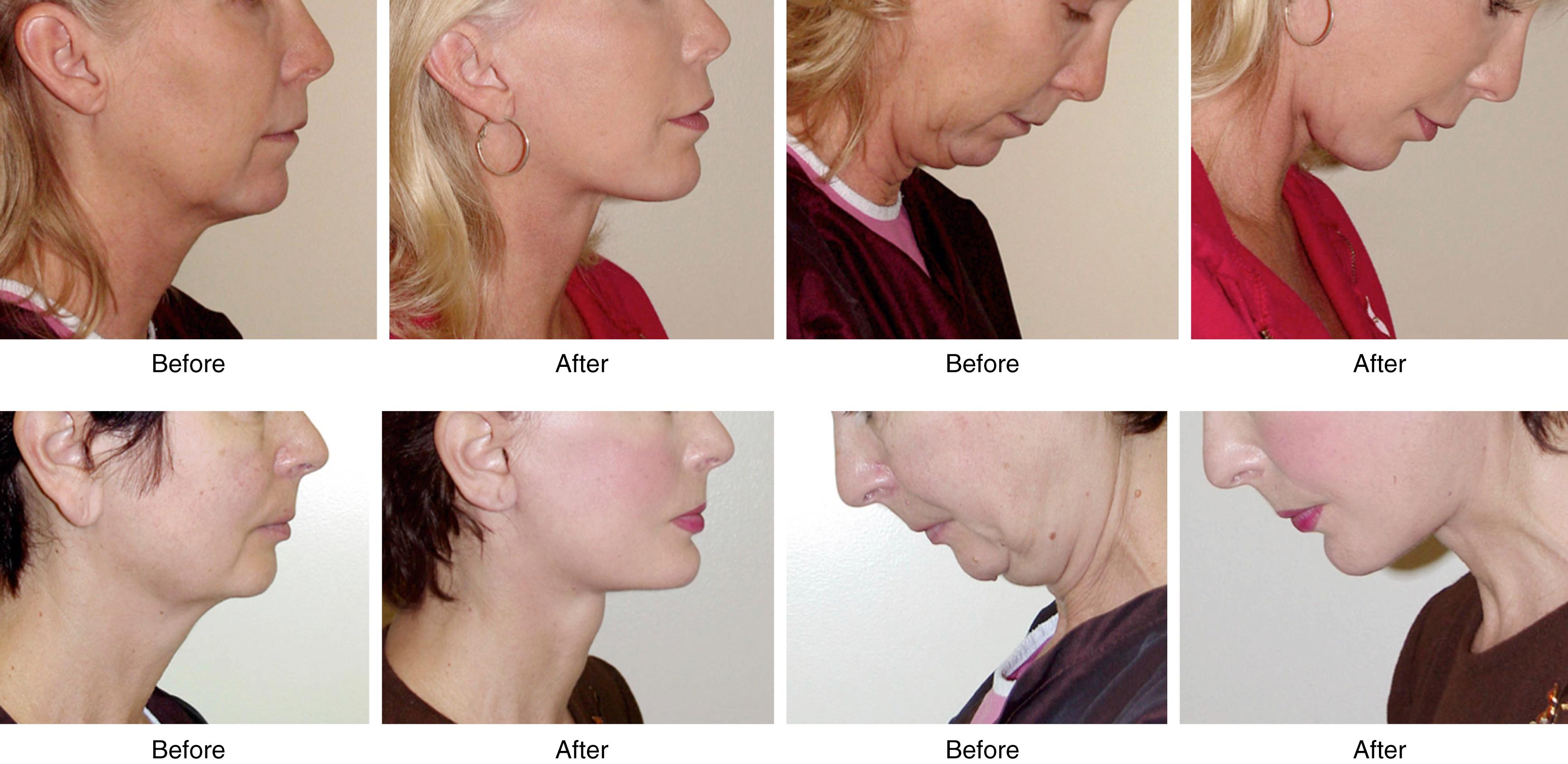 Fig. 67.9, Neck lift with a chin implant. The difference between the presence of poor neck contour and microgenia is commonly misunderstood, and it is a common misconception that placement of a chin implant improves neck contour. When true microgenia is present, however, placing a chin implant in combination with a neck lift will produce a more harmonious and balanced profile and a more esthetic and attractive cervicofacial profile