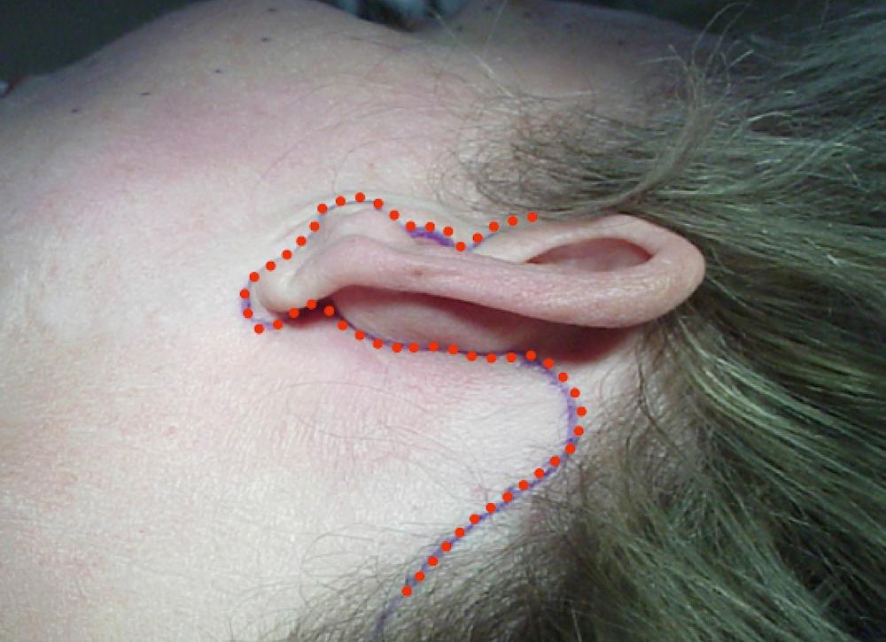 Fig. 67.10, Incision lift plan for a long scar or “extended” neck. If a significant amount of redundant skin is present on the neck it must be excised to obtain the best result, and in such situations it is most logically and effectively excised in the postauricular areas using a periauricular skin incision rather than one under the chin. This incision plan avoids a temporal incision that is of concern to some patients but provides for significant skin removal from the neck.