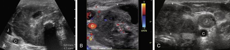 F igure 10-14, Anaplastic cancer (cursors) in different patients. A, Transverse view shows a large, solid, hypoechoic mass with a cystic area and shadowing calcification. The entire right lobe of the thyroid is replaced and the common carotid artery (C) and the internal jugular vein (J) are deviated laterally. B, Transverse view of the right lobe shows a heterogeneous, predominantly solid mass partially encasing the common carotid artery (C) and internal jugular vein (J). C, Transverse view of the left lobe shows a lobulated, solid, hypoechoic mass. There is invasion of the internal jugular vein (J). The common carotid artery is also seen (C).