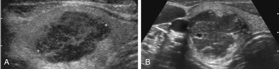 F igure 10-16, Metastatic disease to the thyroid. A, Longitudinal view shows a slightly lobulated, solid, predominantly hypoechoic nodule (cursors) . This was due to metastatic melanoma. B, Transverse view shows a solid, heterogeneous mass (cursors) in the right lobe. This was due to metastatic lung cancer.