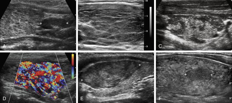 F igure 10-17, Hashimoto's thyroiditis in different patients. A, Longitudinal view of the thyroid (T) shows multiple tiny, hypoechoic nodules scattered throughout an enlarged gland. An enlarged central compartment lymph node (cursors) is seen immediately inferior to the thyroid. B, Longitudinal view shows an enlarged thyroid that is diffusely hypoechoic with multiple thin, echogenic fibrous septations traversing the gland. C, Longitudinal view shows a thyroid that has areas of maintained normal hyperechoic parenchyma and scattered geographic regions of decreased echogenicity without discrete nodules. D, Longitudinal color Doppler view shows intense hypervascularity. E, Longitudinal view of the thyroid shows a discrete, solid, hypoechoic nodule (cursors) within an otherwise normal-appearing thyroid. Fine-needle aspiration confirmed that this nodule was due to Hashimoto's thyroiditis. F, Longitudinal view shows a diffusely heterogeneous gland with a discrete, focal, solid, hypoechoic nodule confirmed cytologically to be Hashimoto's thyroiditis.