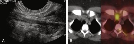 F igure 10-24, Ectopic parathyroid adenoma in the mediastinum. A, Longitudinal view of the inferior neck and the superior mediastinum using a transvaginal probe shows a parathyroid adenoma (cursors) in the substernal region. B, Sestamibi scan confirms a superior mediastinal adenoma (cursors) .