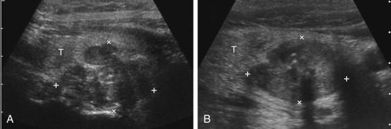 F igure 10-26, Parathyroid cancer in different patients. A, Longitudinal view shows a large, lobulated, hypoechoic, solid mass (cursors) posterior to the thyroid (T). B, Longitudinal view shows a large, hypoechoic, solid mass (cursors) posterior to the thyroid (T). Small areas of central calcification are present.