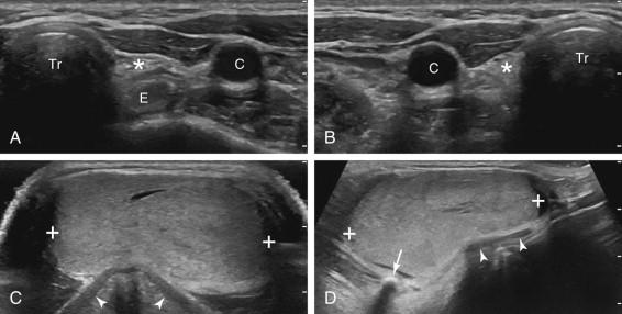 e -F igure 10-2, Ectopic thyroid. Transverse views of the left (A) and right (B) thyroid beds (asterisks) show no visible thyroid tissue. Transverse (C) and longitudinal (D) views of the midline neck superior to the thyroid bed show ectopic thyroid tissue (cursors) anterior to the thyroid cartilage (arrowheads) and the hyoid bone (arrow) . See Video 10-2 for transverse video starting at the level of the hyoid bone proceeding inferiorly, showing the full extent of the ectopic thyroid and the empty thyroid bed.