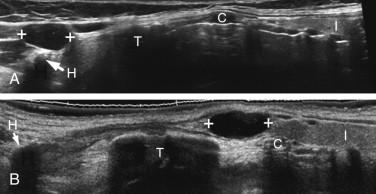 F igure 10-3, Thyroglossal duct cysts. Longitudinal panoramic views in different patients show the thyroid isthmus (I), cricoid cartilage (C), thyroid cartilage (T), and hyoid bone (H). A, Thyroglossal duct cyst (cursors) is located in the typical location anterior to the hyoid bone. B, Thyroglossal duct cyst (cursors) located in an infrahyoid location.