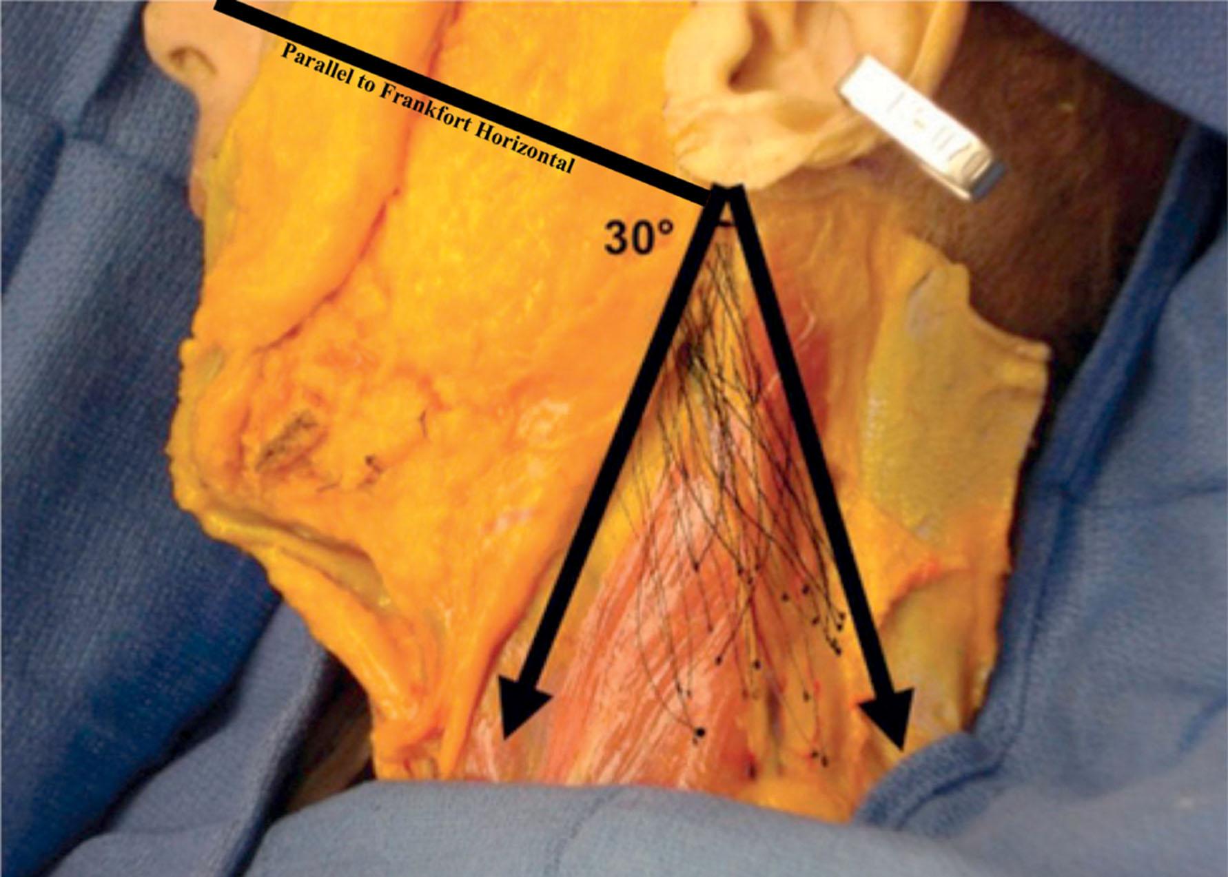 Figure 9.10.4, Danger zone of injury for the great auricular nerve (GAN) can be defined by drawing a vertical line through the midlobule perpendicular to the Frankfort's horizontal (parallel line shown in figure), followed by a 30° angle constructed posteriorly from the midlobule. The transparent tracings of each individual cadaver dissection were overlaid to document nerve location, as shown in this 70-year-old female cadaver. All nerves lay within a 30° angle (black lines).