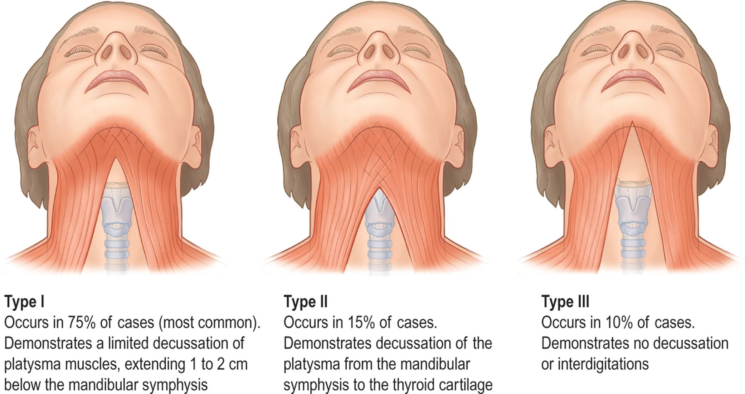 Figure 9.10.5, Variations in platysma anatomy in the submental region. Type I: interdigitation of the platysma muscle 1–2 cm posterior to the mandibular symphysis. Type II: interdigitation of the platysma muscles from mandibular symphysis to the thyroid cartilage. Type III: no interdigitation of the platysma muscles.