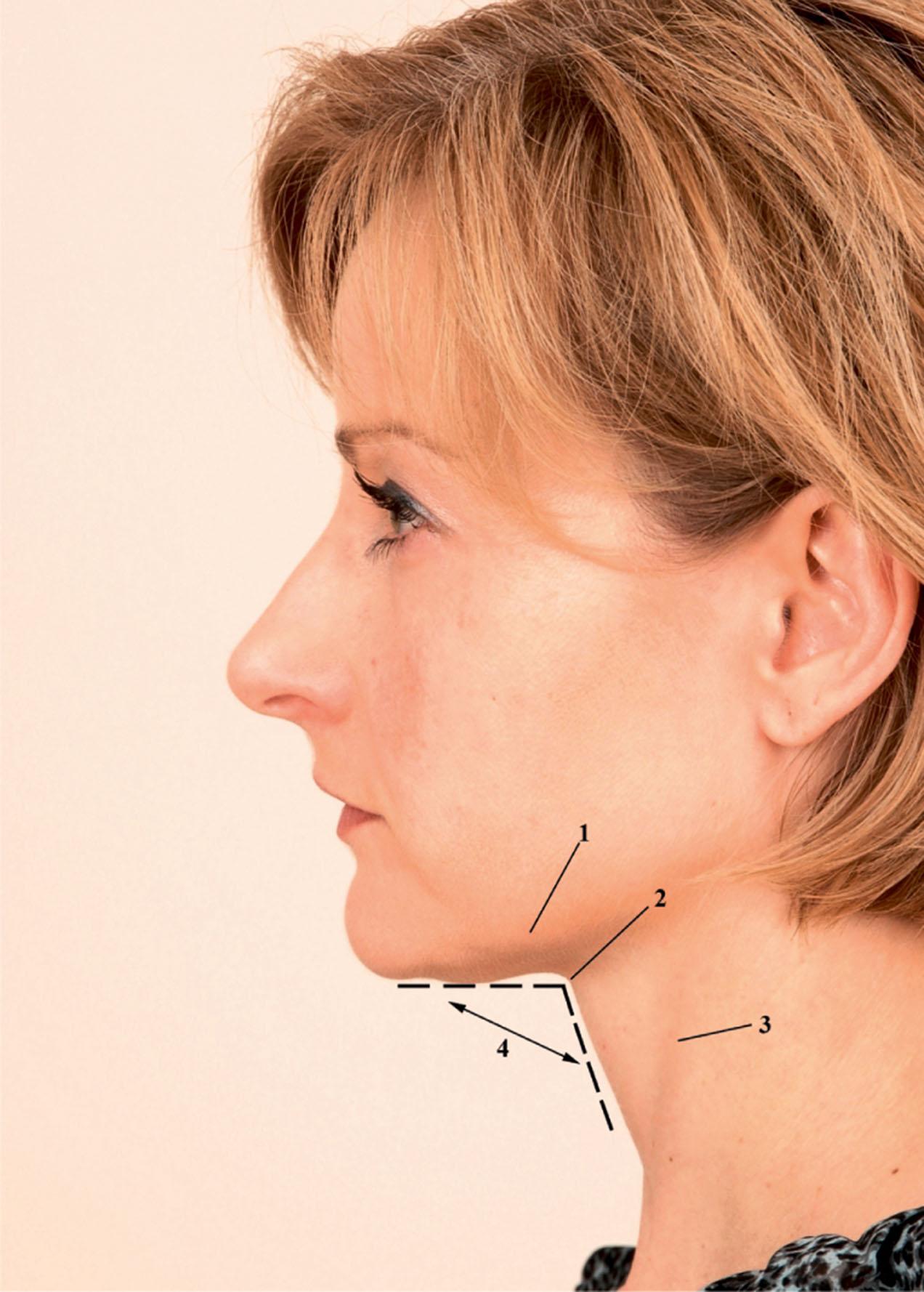 Figure 9.10.8, Profile view demonstrates the attributes of a youthful neck including (1) a cervicomental angle of approximately 105°; (2) a distinct inferior mandibular border; (3) a slightly visible thyroid cartilage; and (4) a visible anterior border of the sternocleidomastoid muscle.