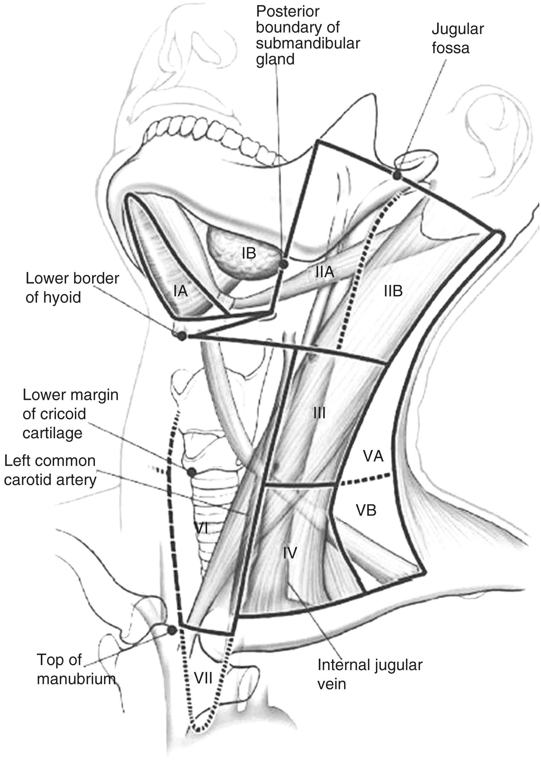 Figure 8.1, Diagram outlining cervical node levels in relation to neck anatomy. This figure shows American Joint Committee on Cancer classification of cervical lymph nodes (LN). Level 1 LN are sub-mental and sub-mandibular; level 2 LN are upper internal jugular chain nodes; level 3 LN are middle internal jugular chain nodes; level 4 LN are lower internal jugular chain nodes; level 5 LN are spinal accessory chain nodes and transverse cervical chain nodes; and level 6 LN are anterior cervical nodes