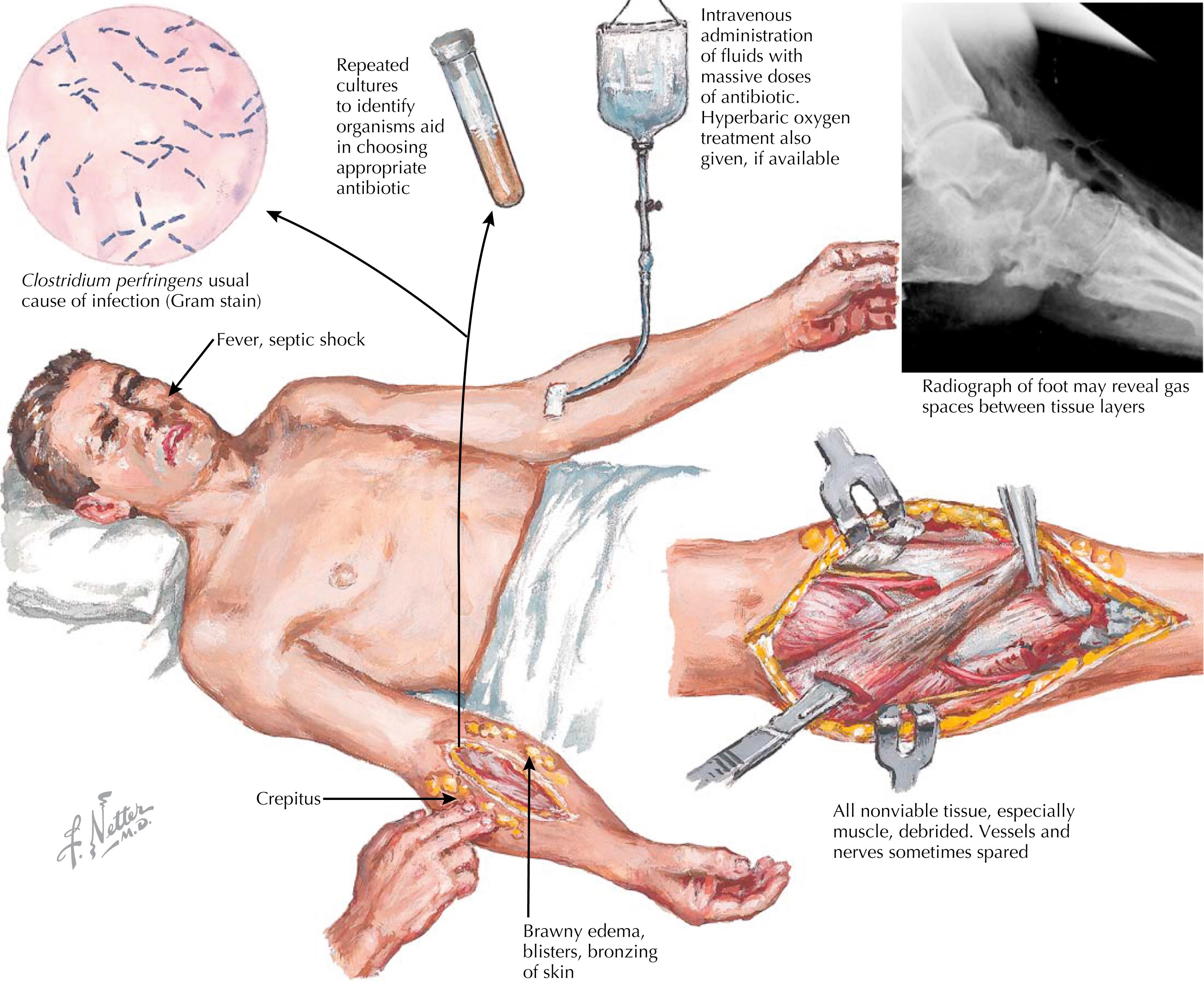 Fig. 48.2, Necrotizing soft-tissue infections.