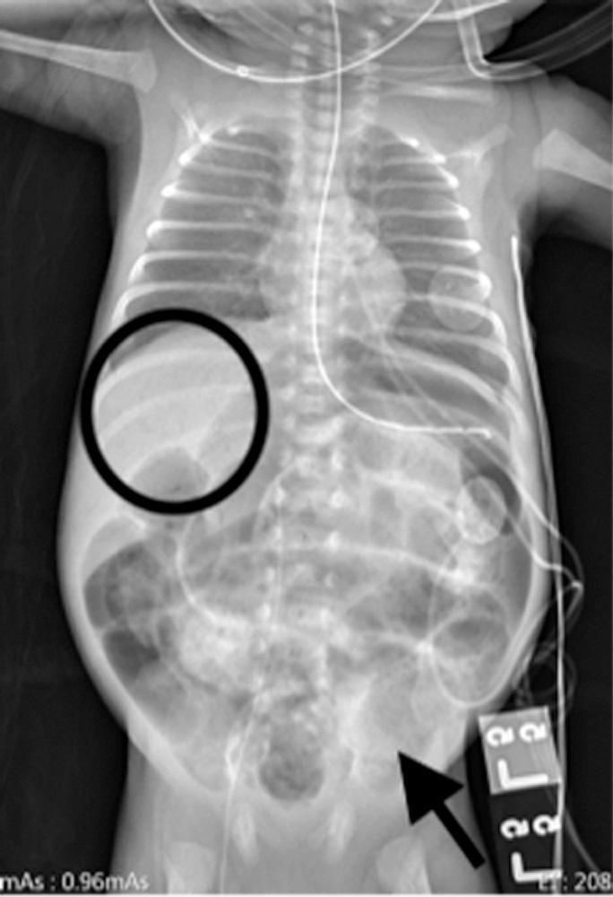 Fig. 22.1, Abdominal plain film x-ray revealing abnormal diffuse bowel dilation, pneumatosis within the right and left lower quadrants with portal venous gas (circled).