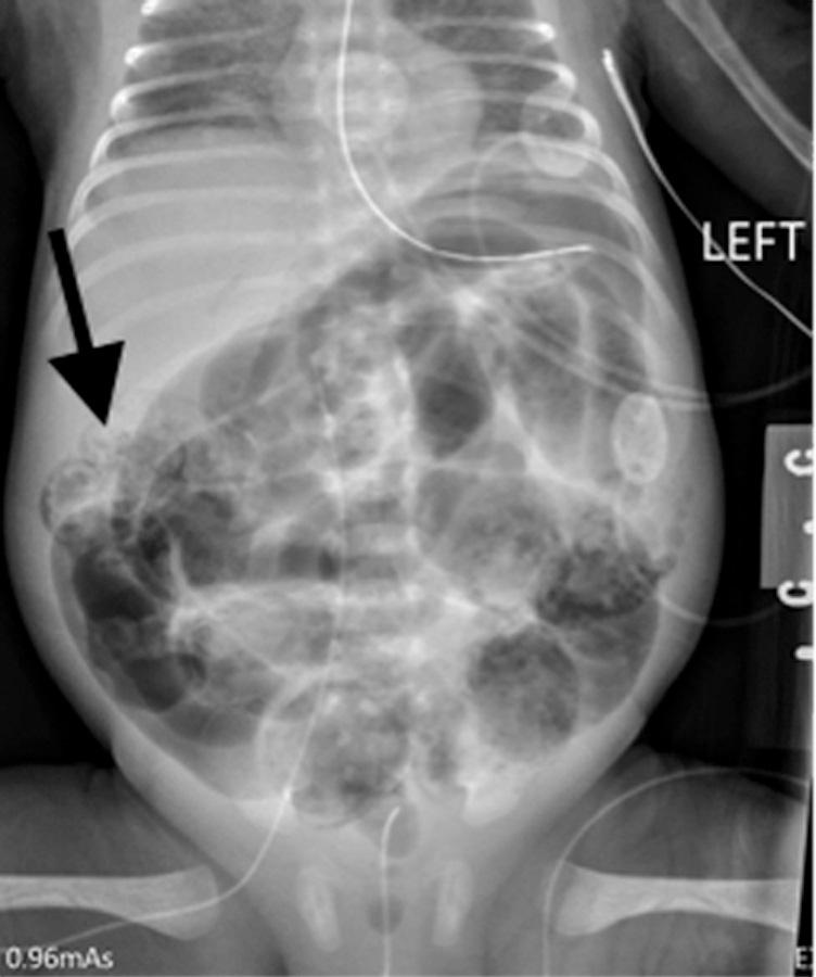 Fig. 22.2, Abdominal plain film x-ray revealing persistent bowel dilation, abnormal gas pattern, pneumatosis (arrow), and now multiple fixed bowel loops.