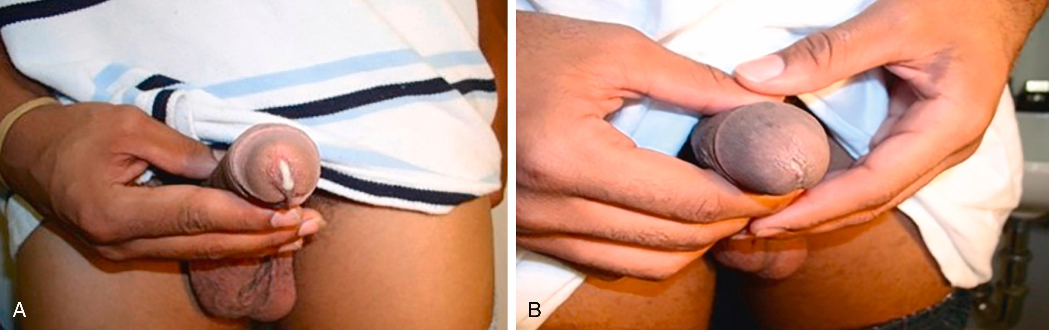 FIGURE 275-2, Urethral discharge. A , Gonococcal urethritis.