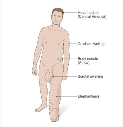 Figure 7-1, Cutaneous manifestations of nematodal infections.